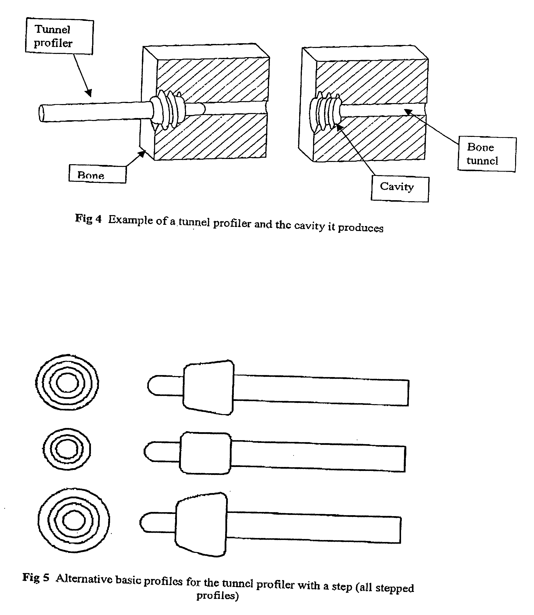 Prosthetic implant assembly