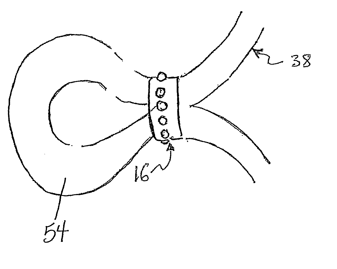 Endoscopic full thickness gastric reduction apparatus and method