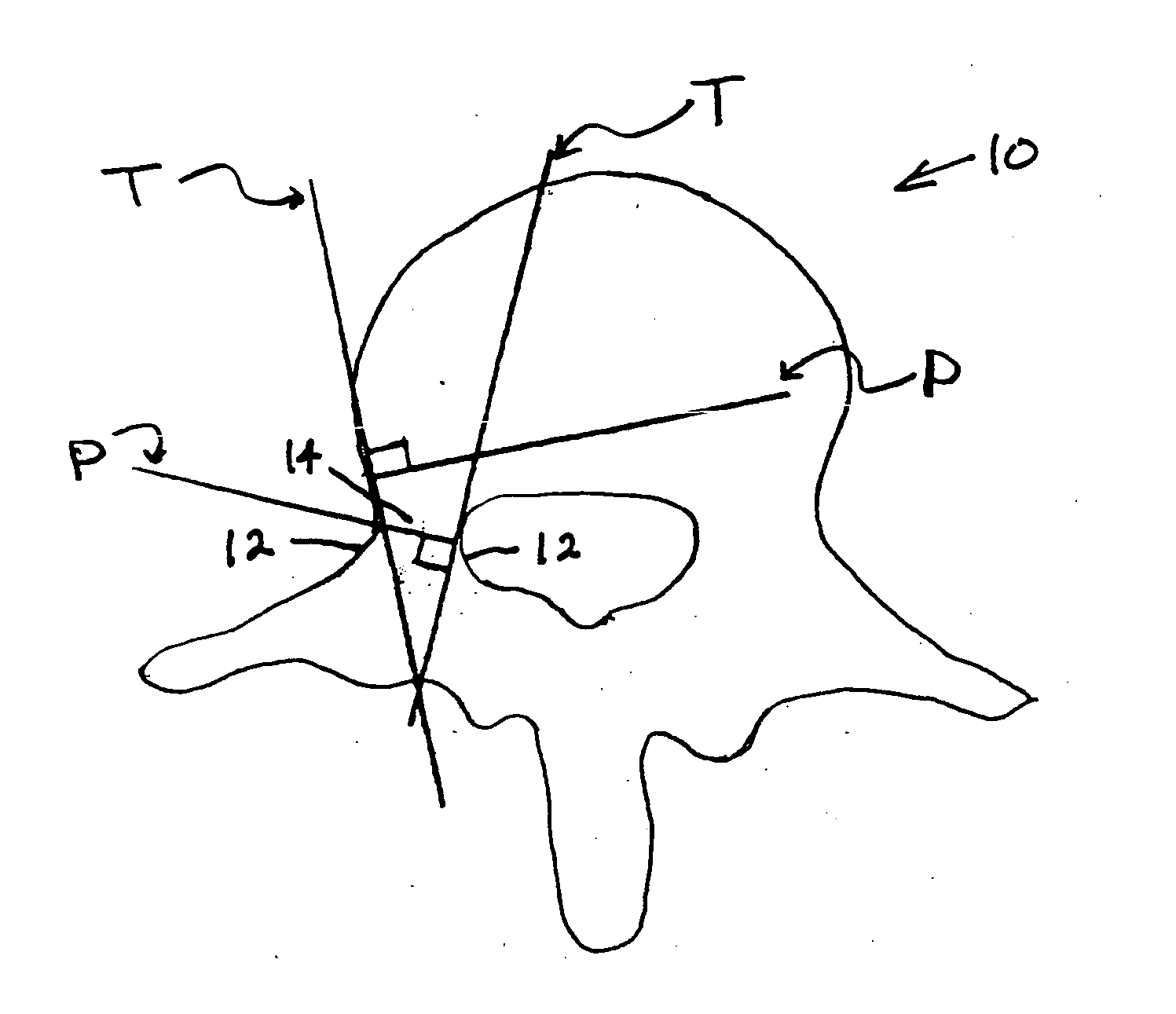 Methods for determining pedicle base circumference, pedicle isthmus and center of the pedicle isthmus for pedicle screw or instrument placement in spinal surgery