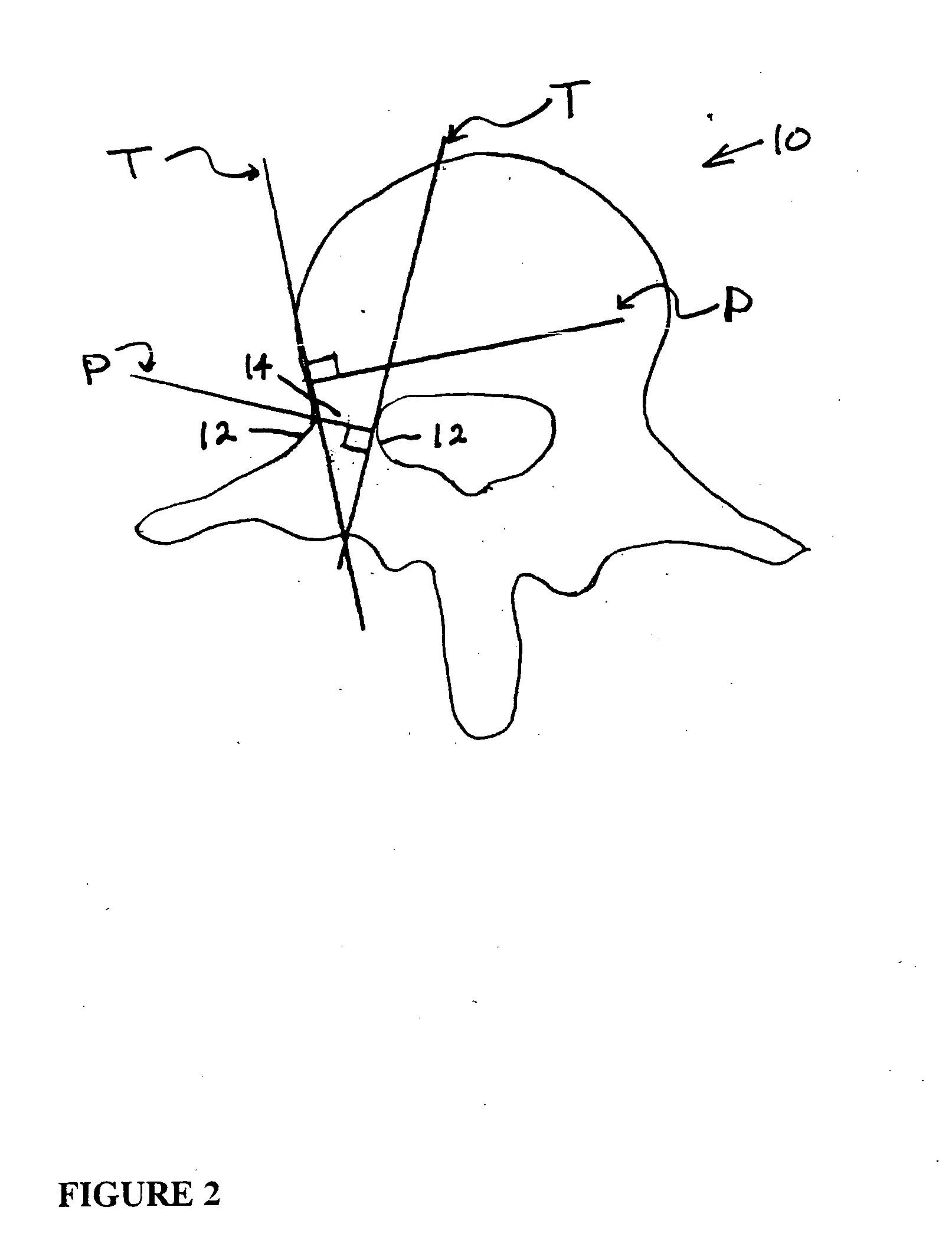 Methods for determining pedicle base circumference, pedicle isthmus and center of the pedicle isthmus for pedicle screw or instrument placement in spinal surgery