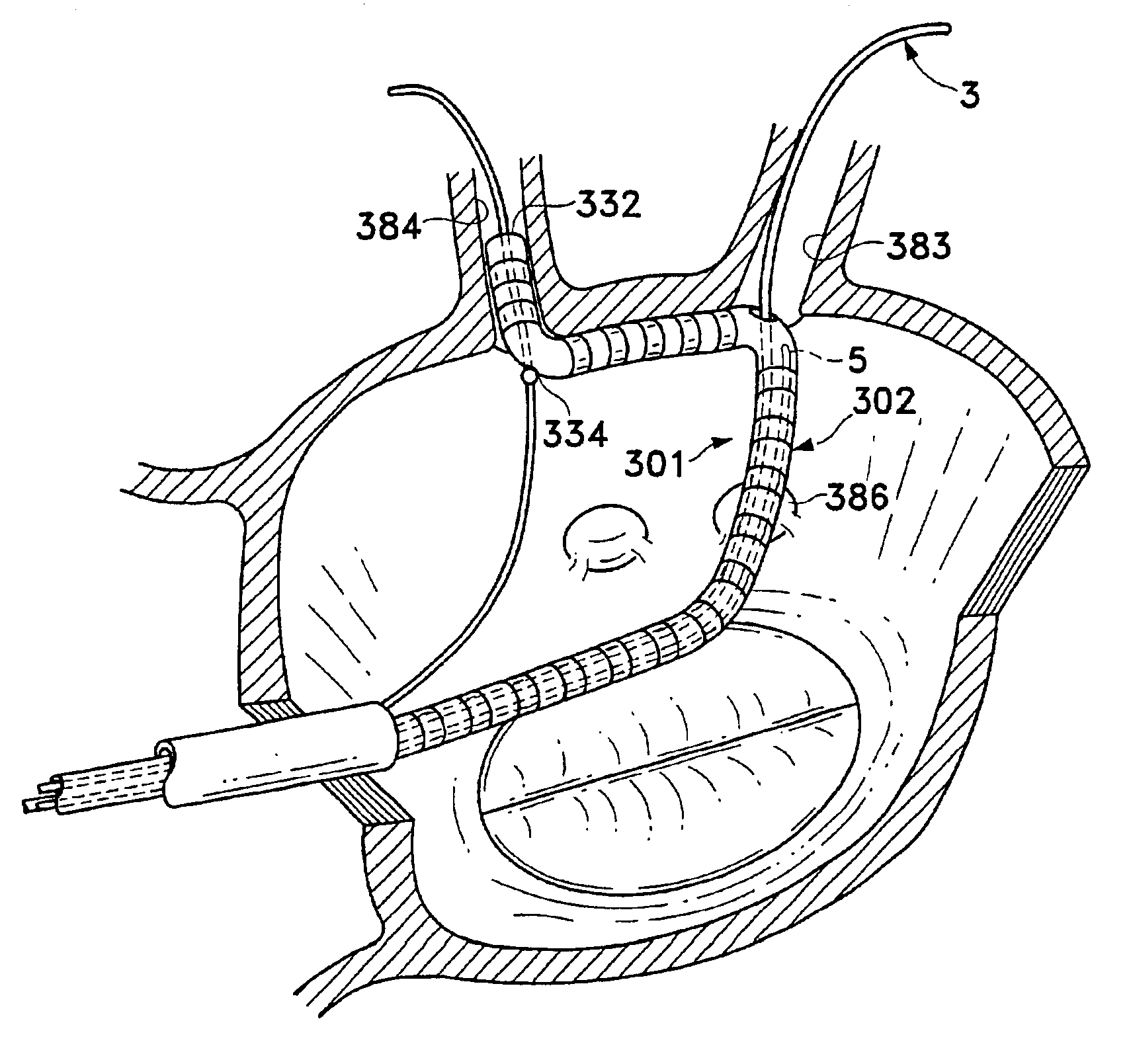 Tissue ablation device and method of use