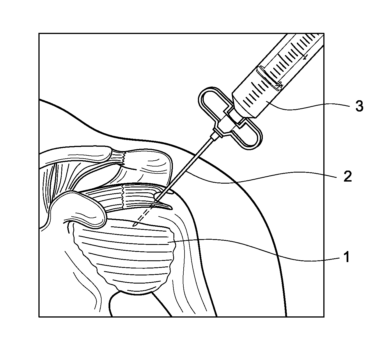 Arthroscopic harvesting and therapeutic application of bone marrow aspirate