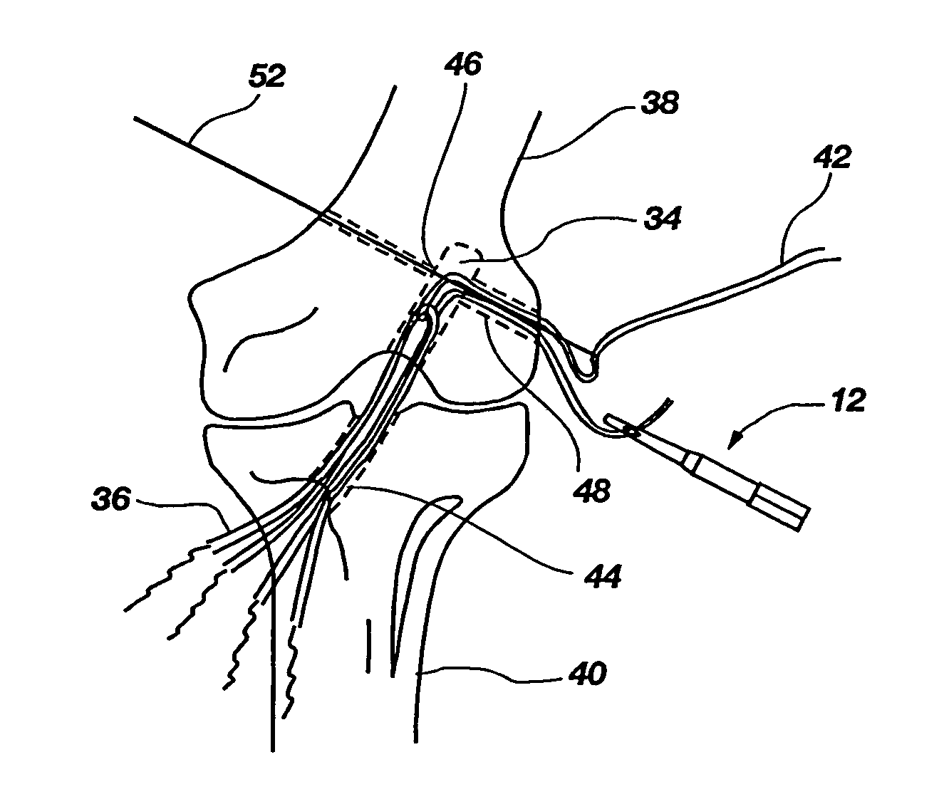 Method and implant for securing ligament replacement into the knee