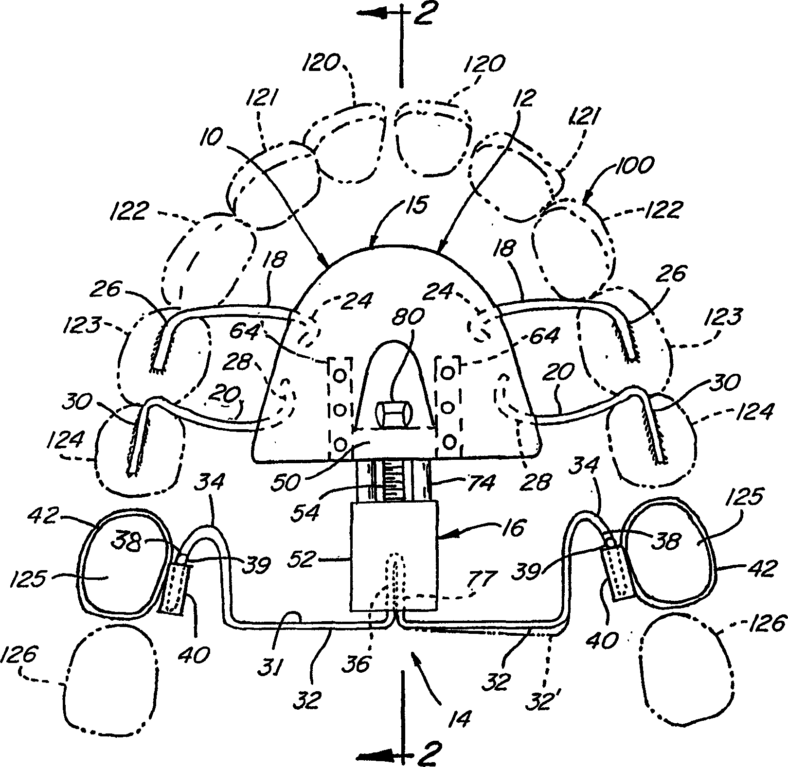 Orthodontic distallizing appliance