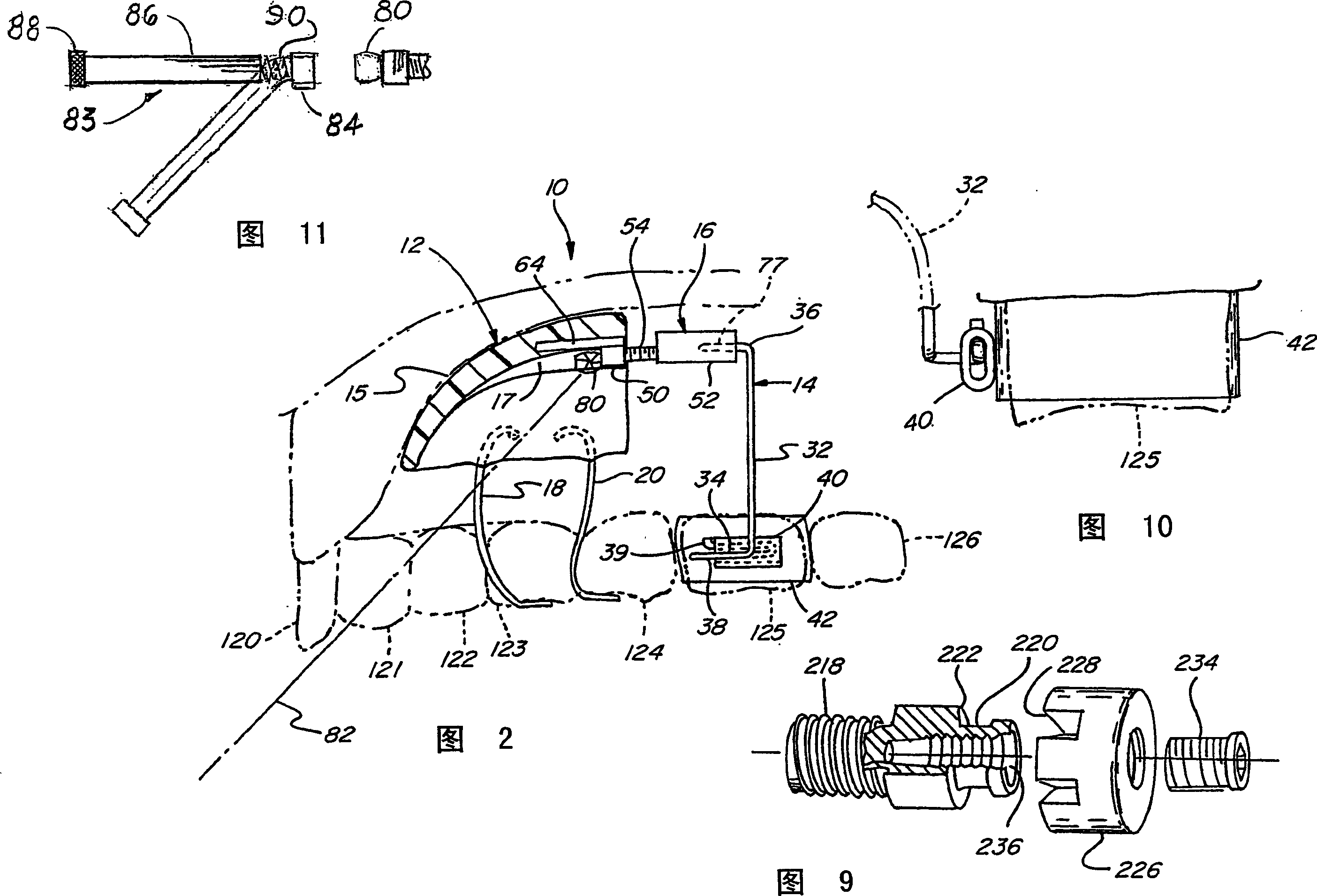 Orthodontic distallizing appliance