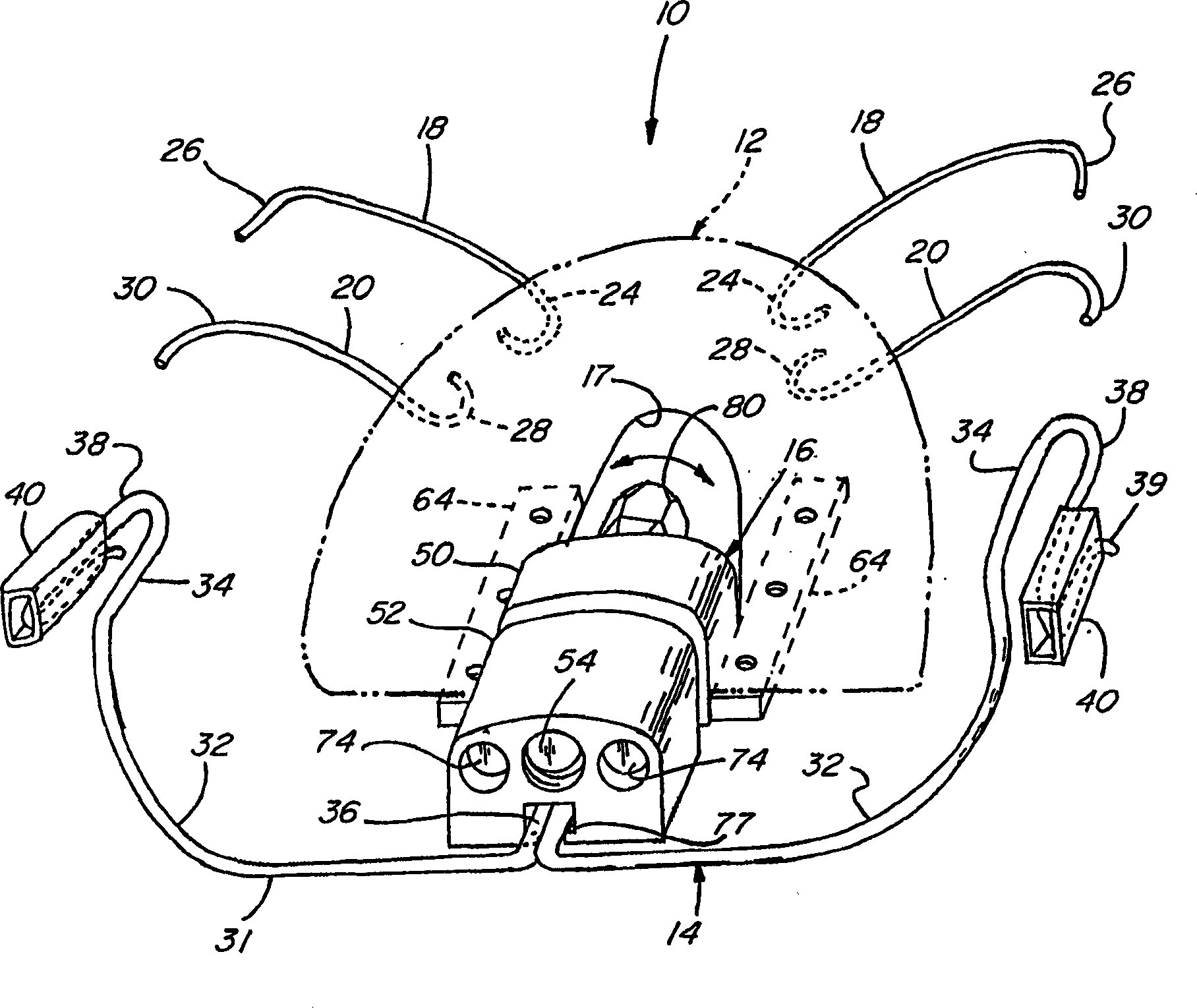 Orthodontic distallizing appliance