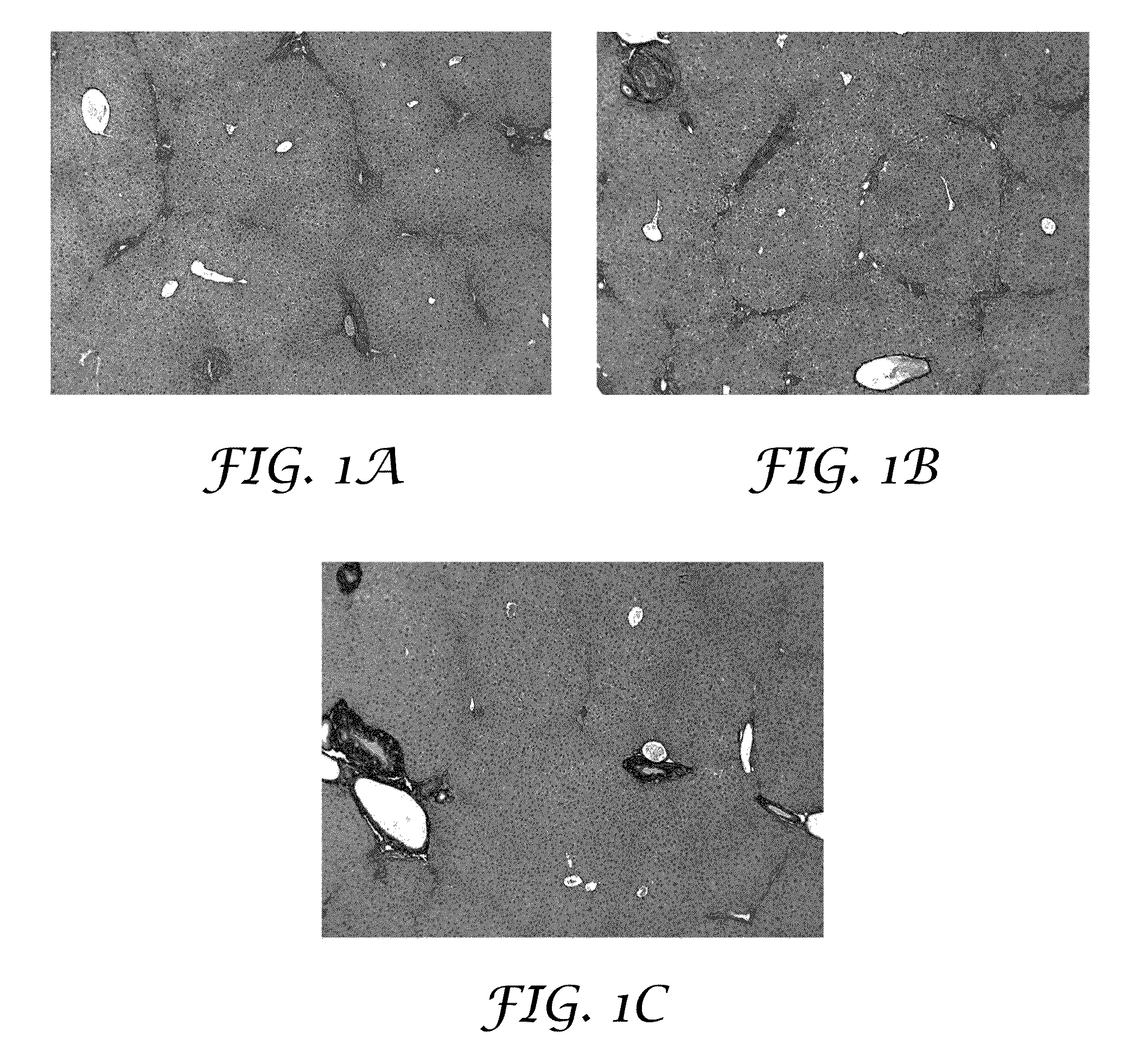 Methods and formulations for treating chronic liver disease