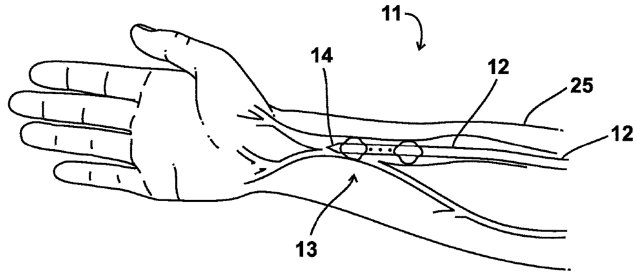 Method and apparatus for enhancing the maturation rate of an arteriovenous fistula