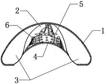 a breast implant