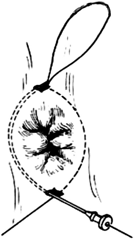 Threading implantation device for surgical annular constriction