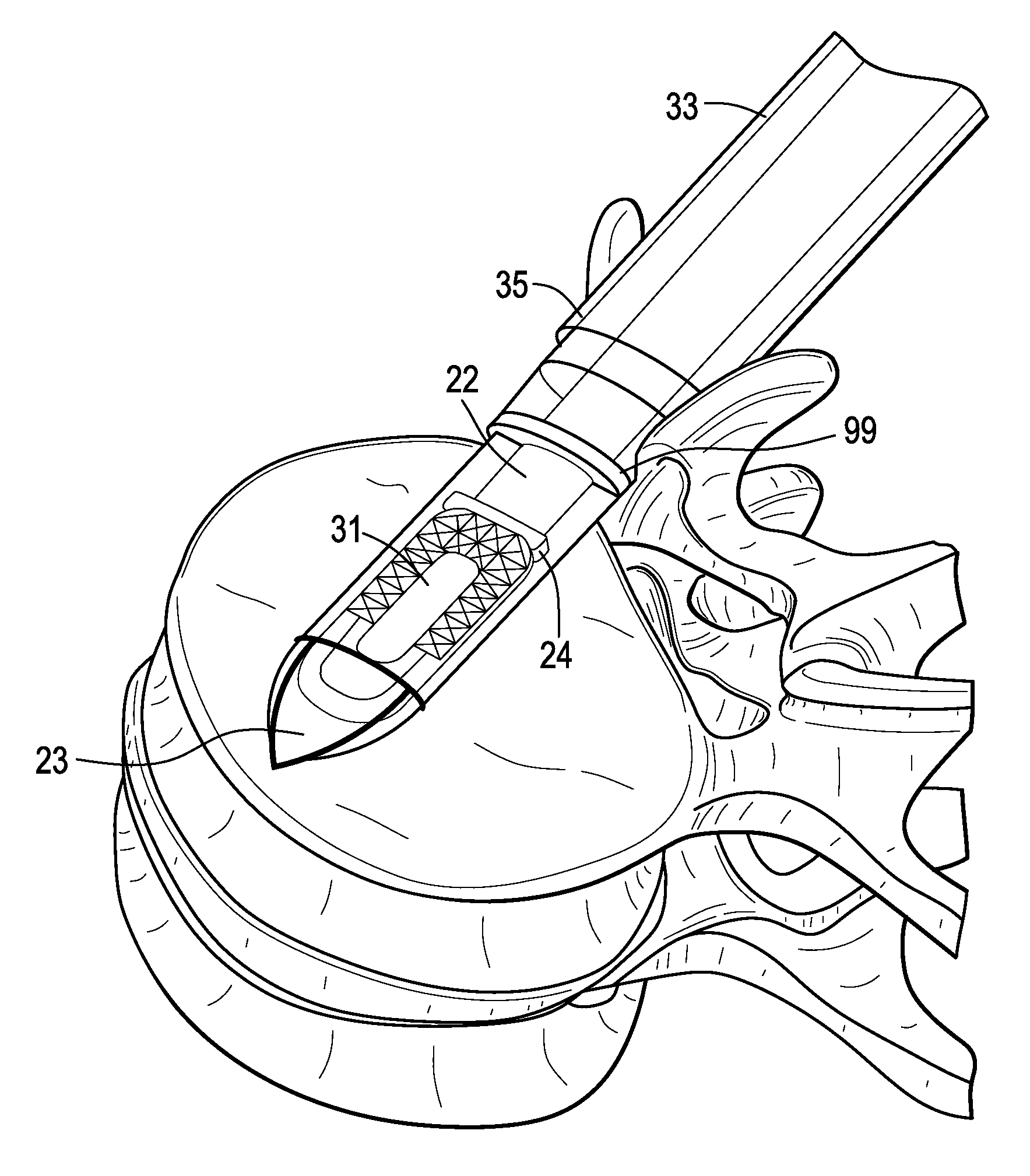 Enhanced cage insertion device