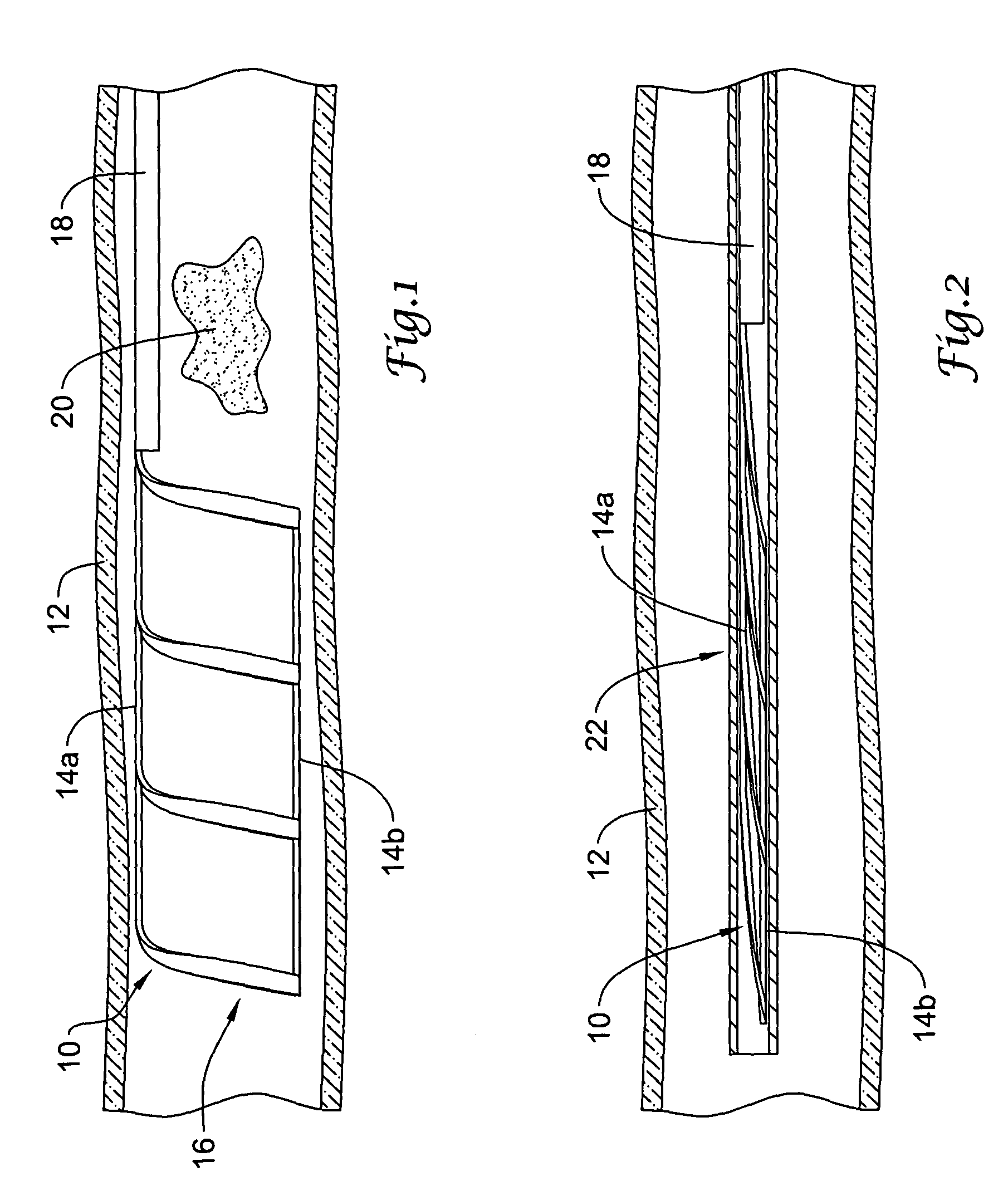 Laser-cut clot puller