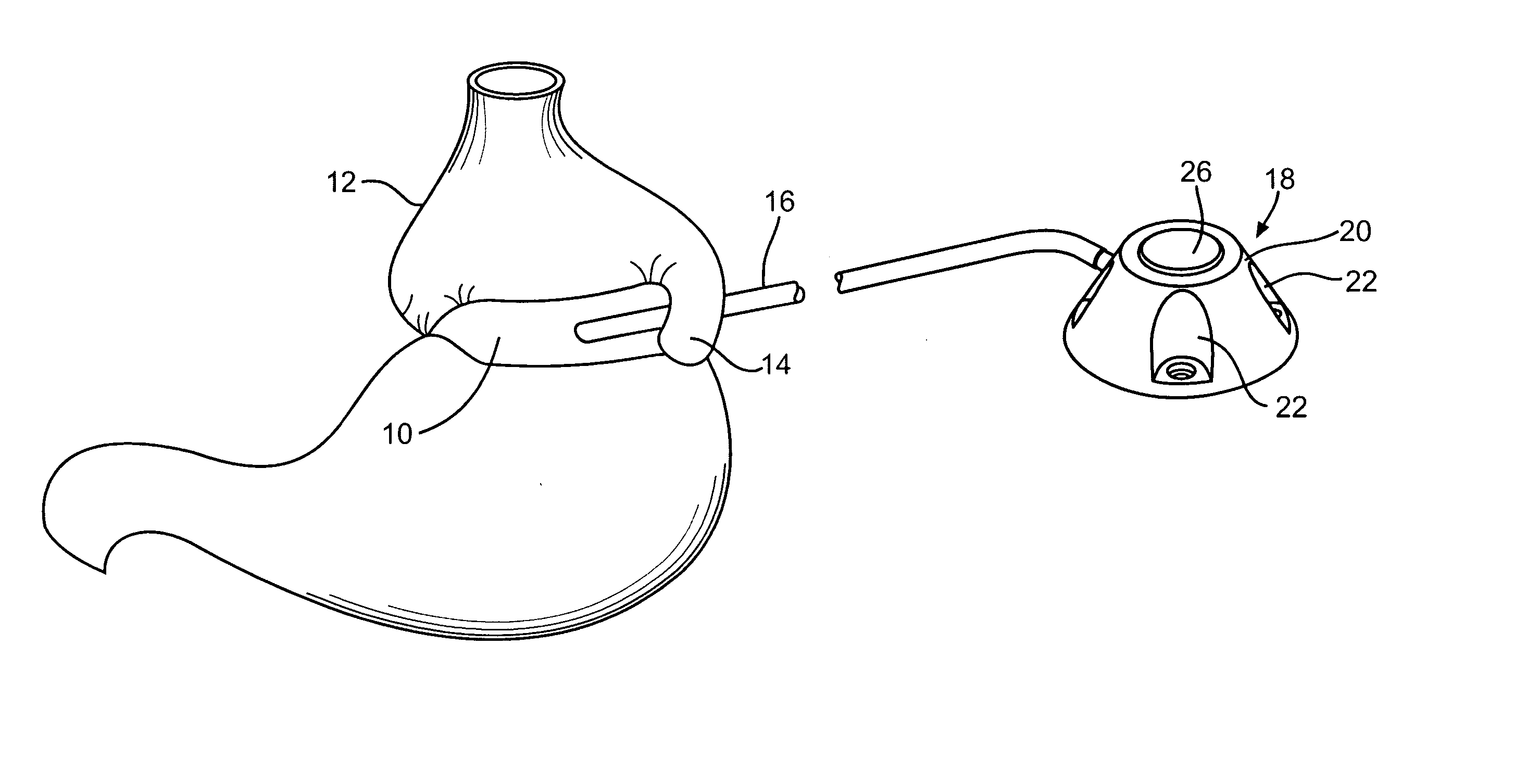 Subcutaneous injection port for applied fasteners