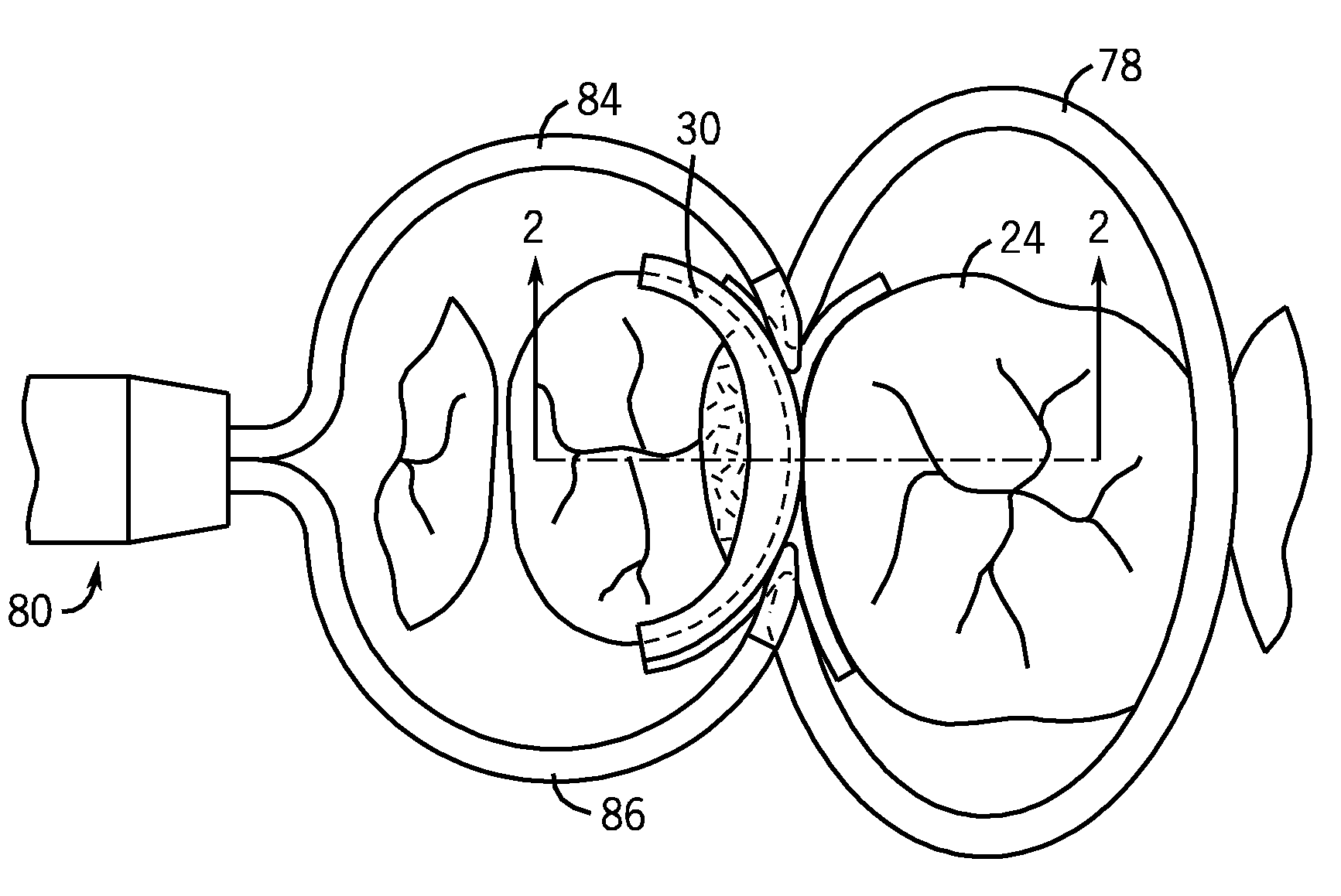 Dental Kits And A Seamless, Single Load Cavity Preparation And Filling Technique