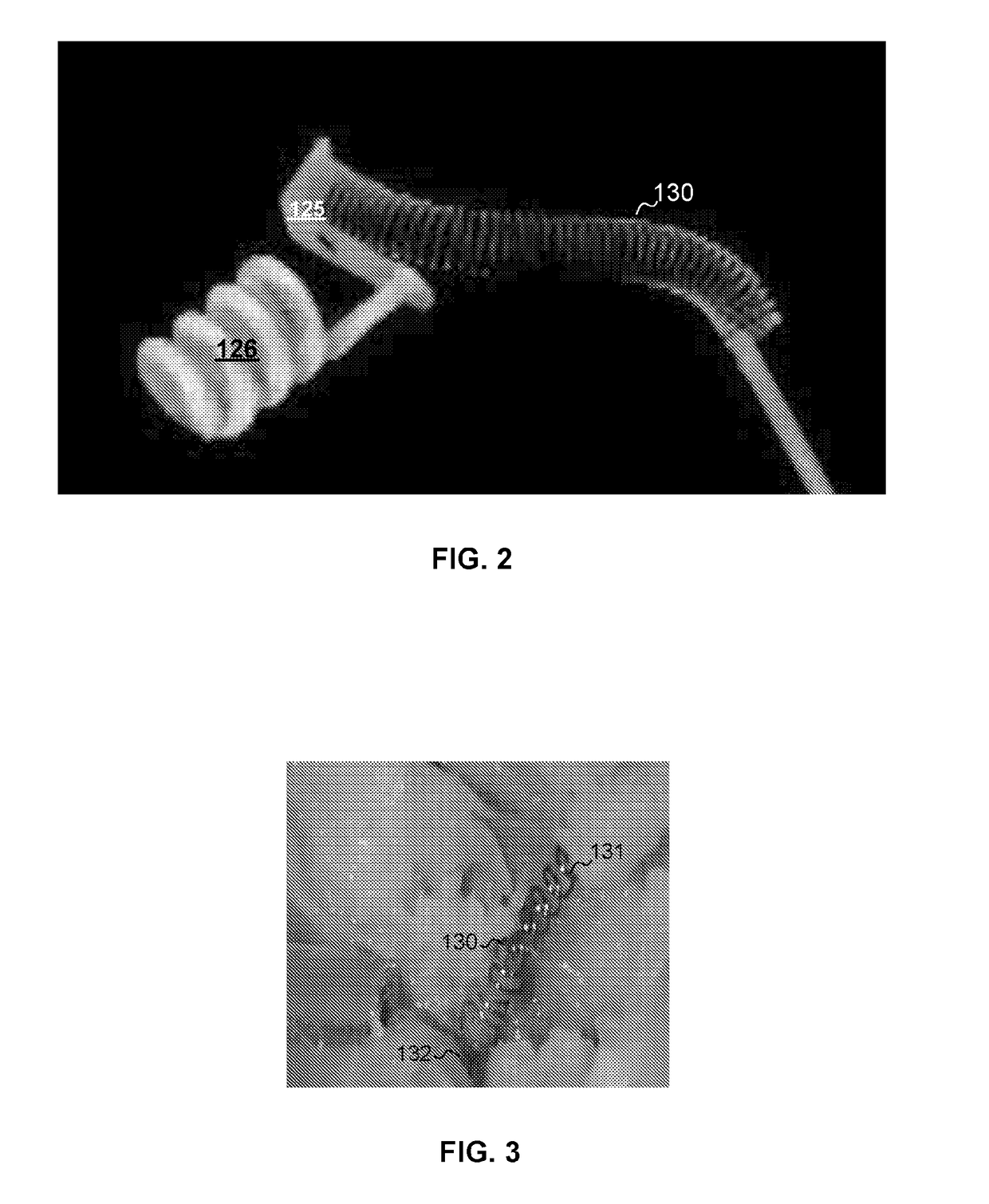 Implanted electrical lead for pacemaker