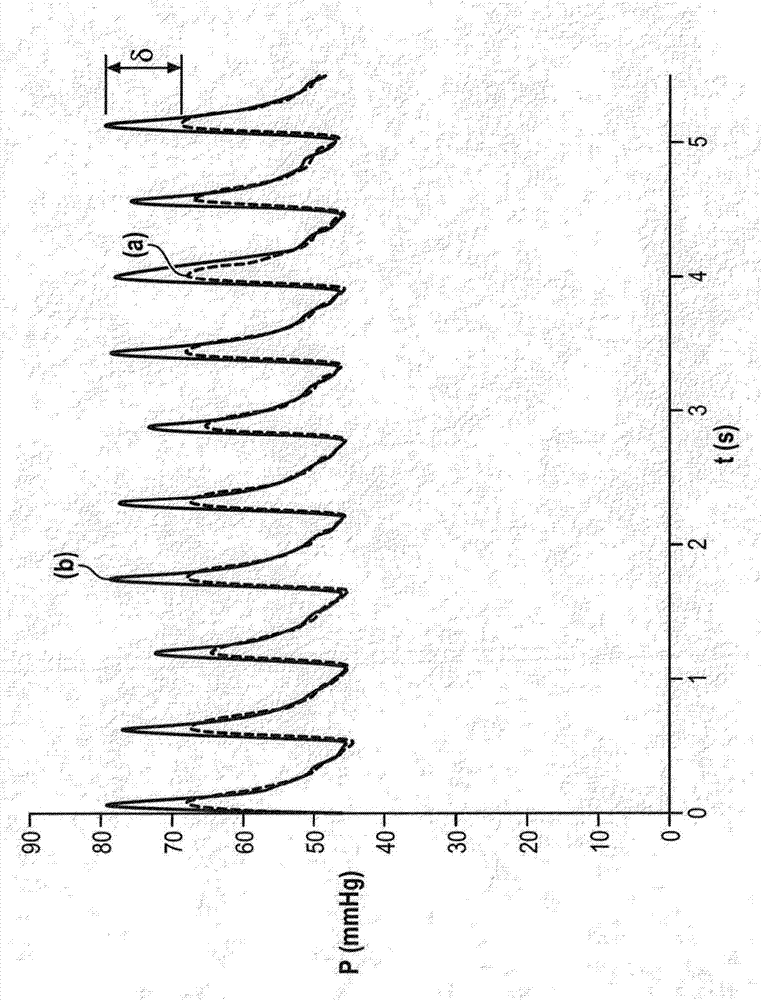 Method and device for monitoring blood pressure measurement by arterial catheterization of a patient