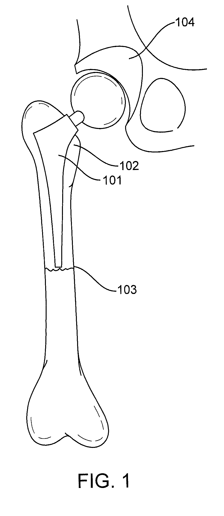 Periprosthetic fracture management enhancements