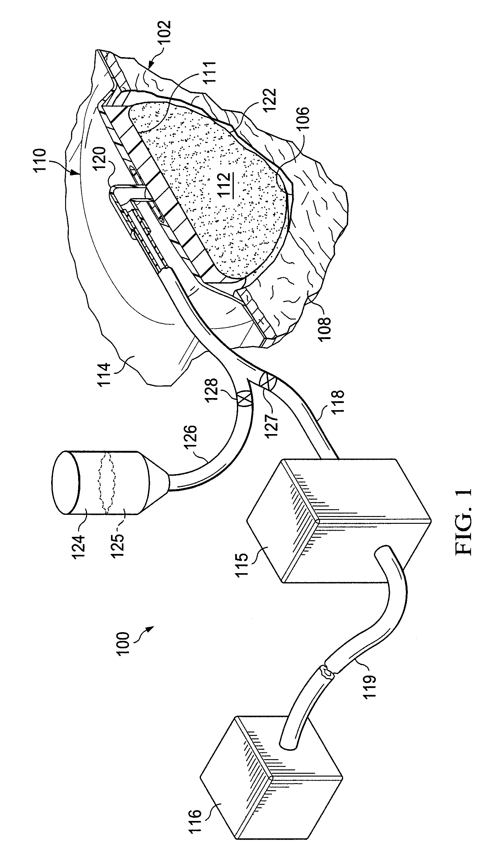 Stimulation of cartilage formation using reduced pressure treatment