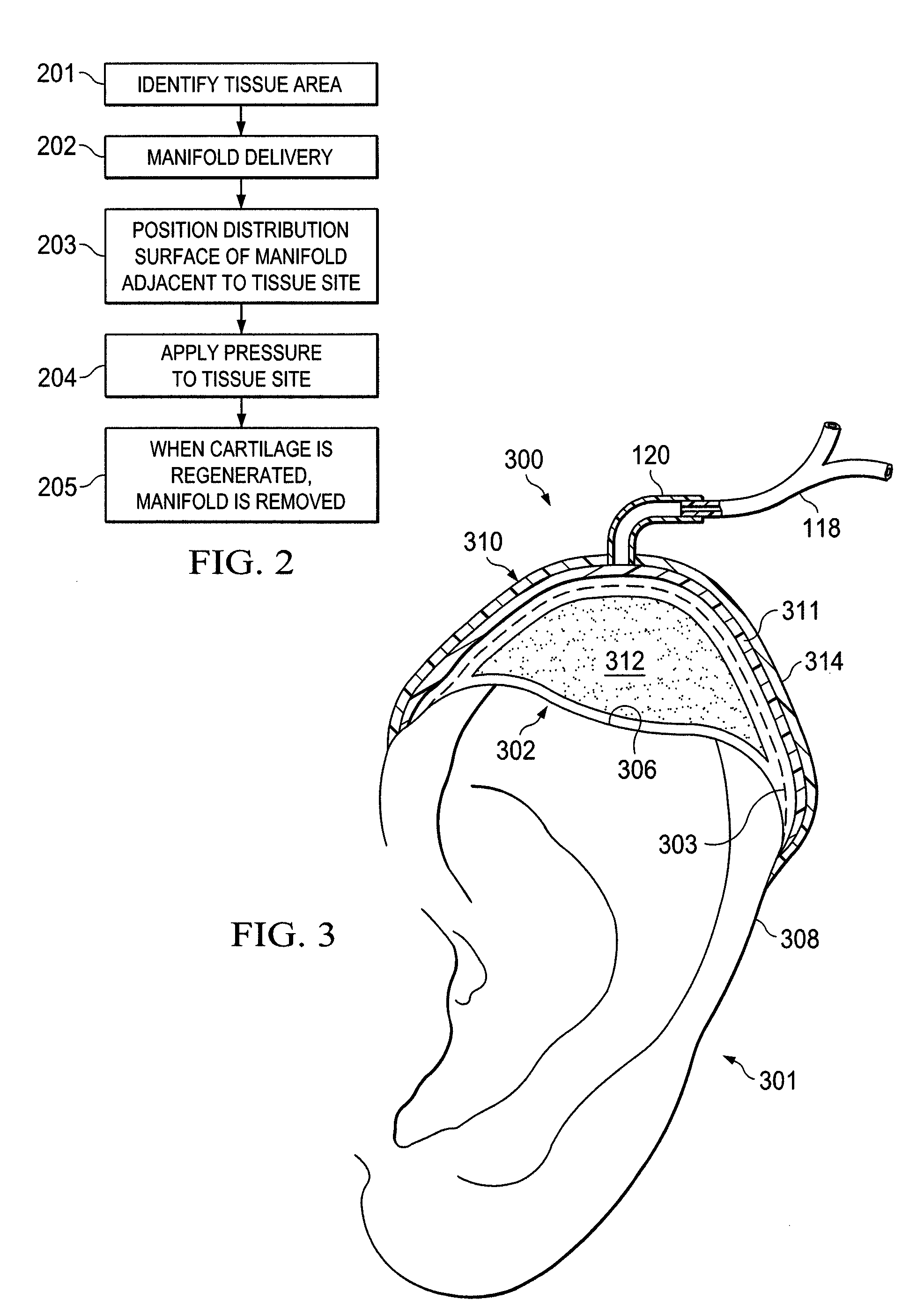 Stimulation of cartilage formation using reduced pressure treatment