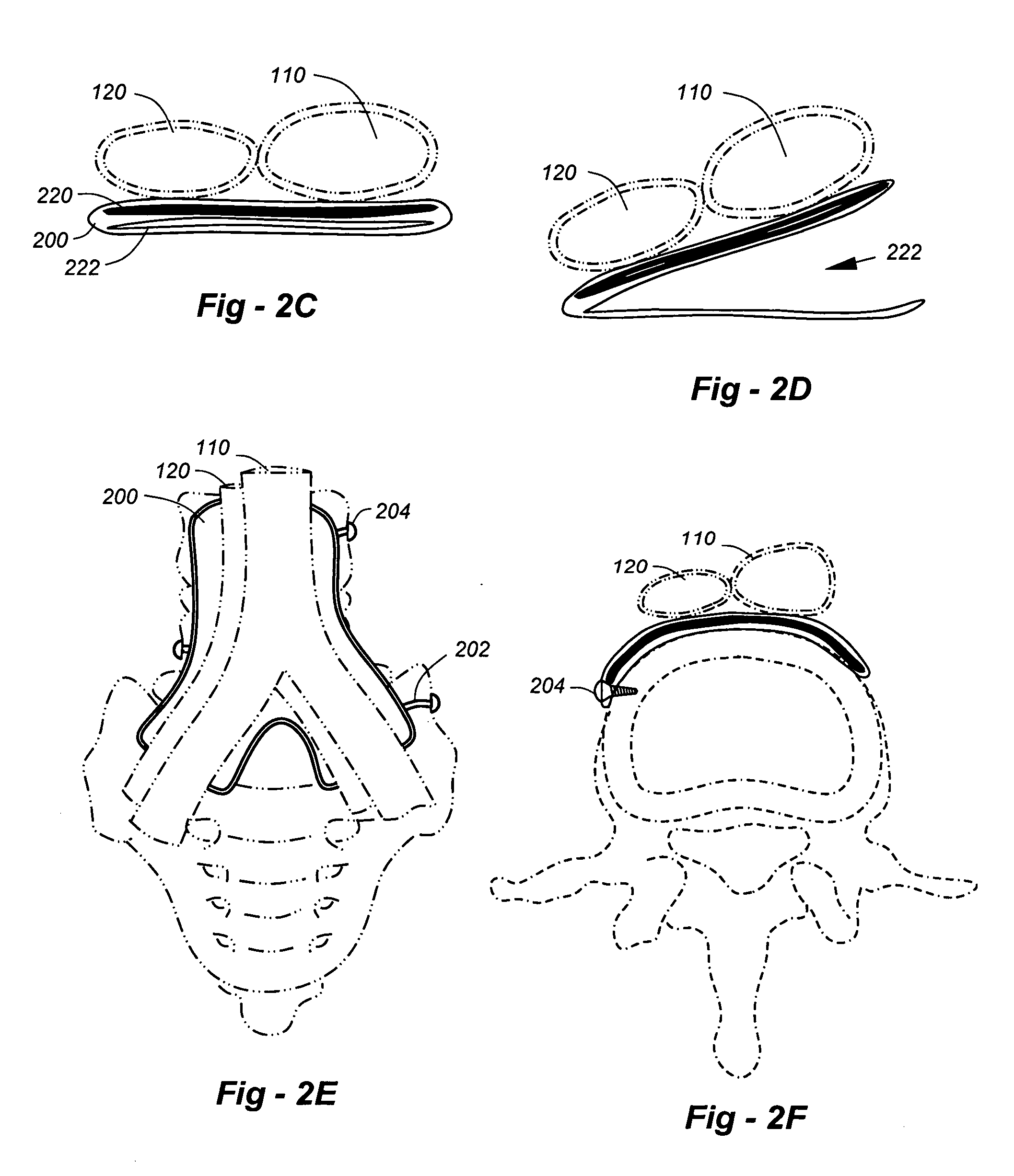 Protecting biological structures, including the great vessels, particularly during spinal surgery