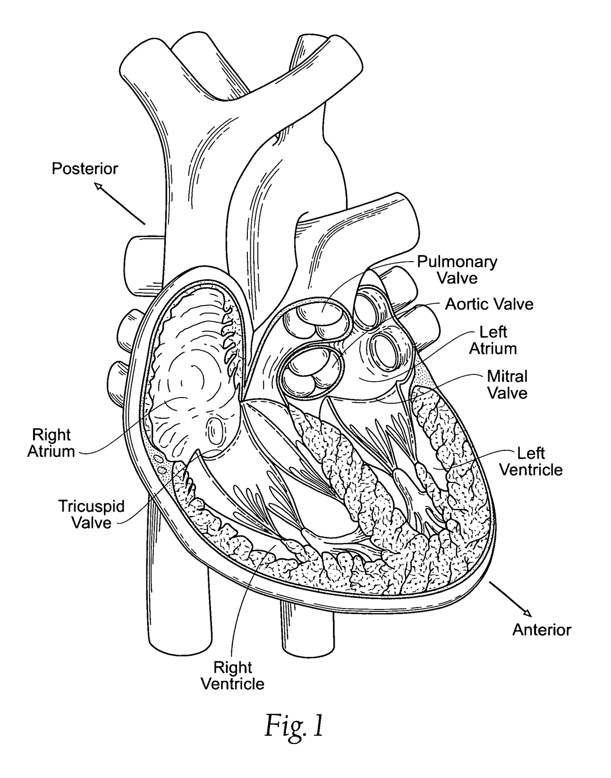 Devices, systems, and methods for reshaping a heart valve annulus