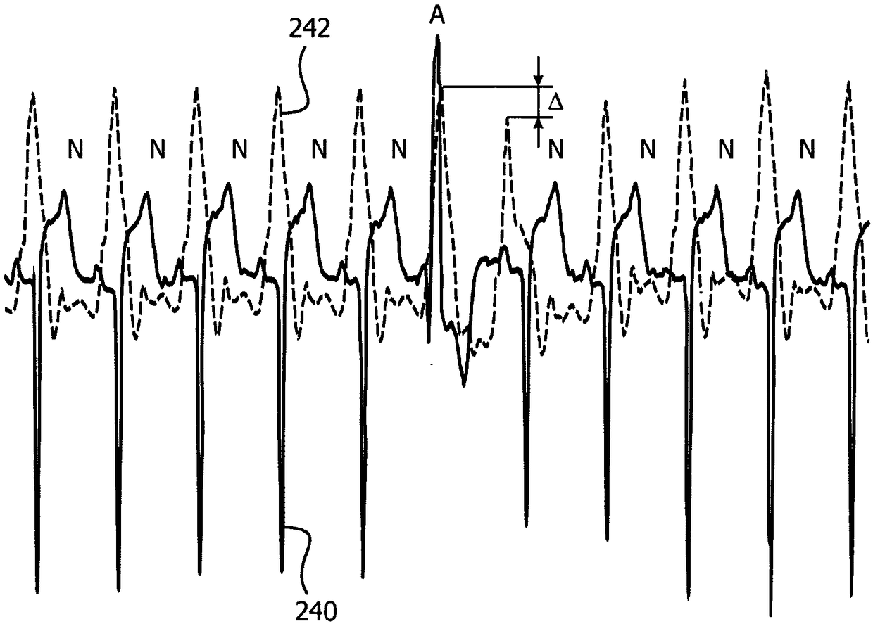 Template-based analysis and classification of cardiovascular waveforms