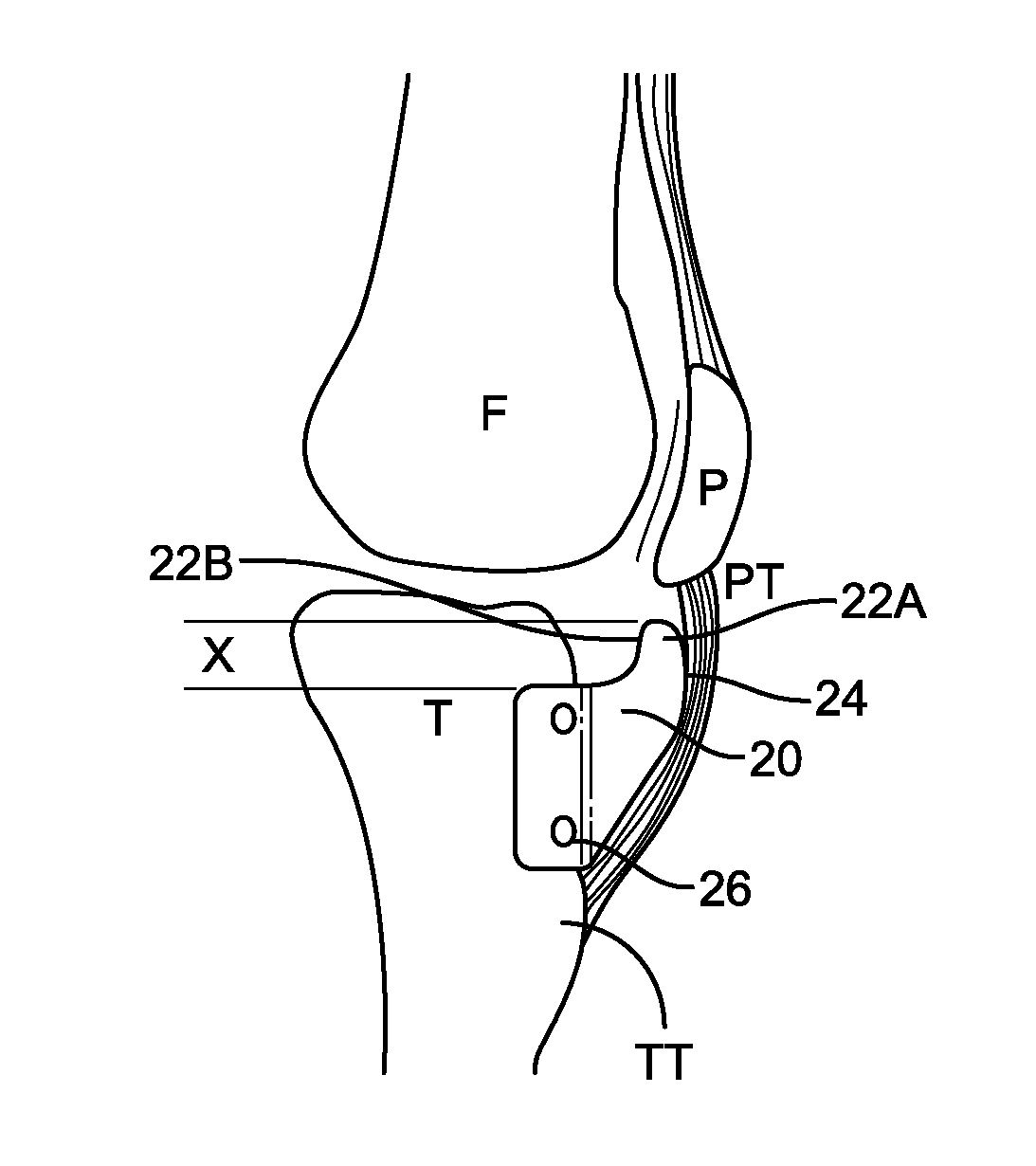 Apparatus and methods for treatment of patellofemoral conditions