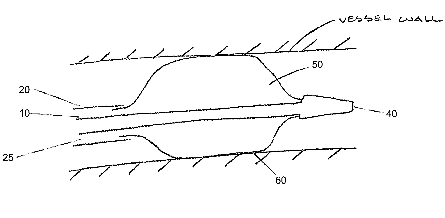 Drug Coated Balloon Catheter