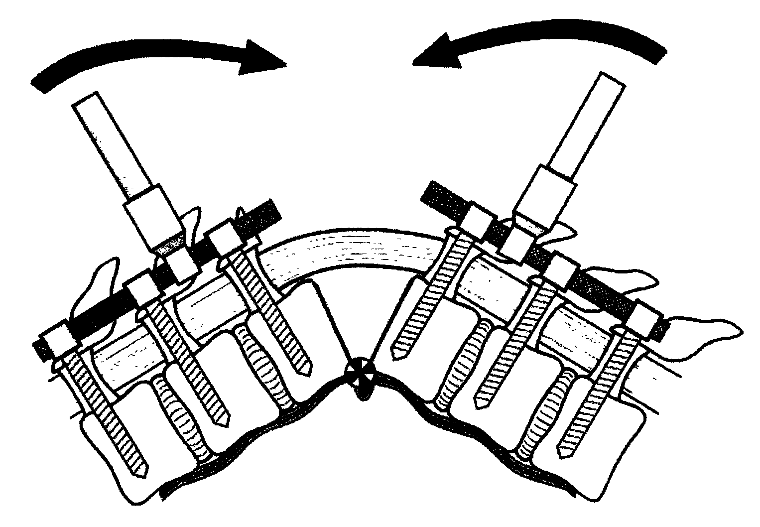 Spine osteotomy bone knife