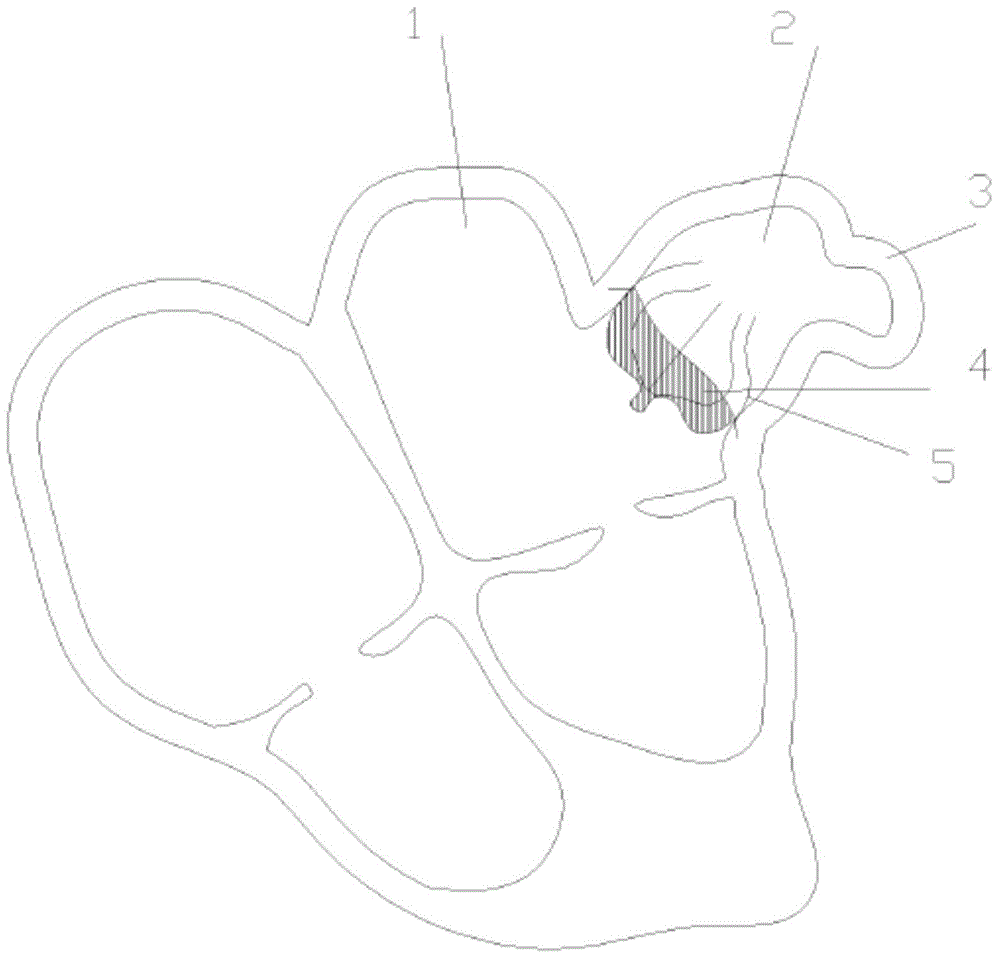 Device for left auricle ligation and using method of device