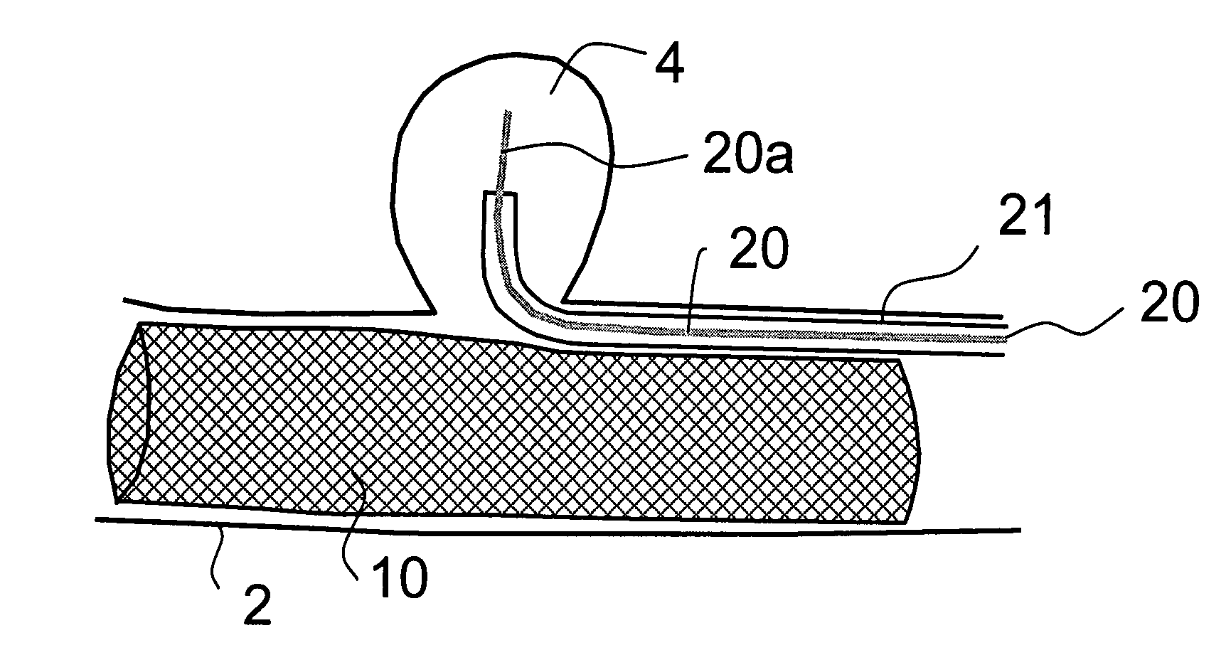 Methods and devices for reducing or blocking blood flow to a selected blood vessel or part thereof