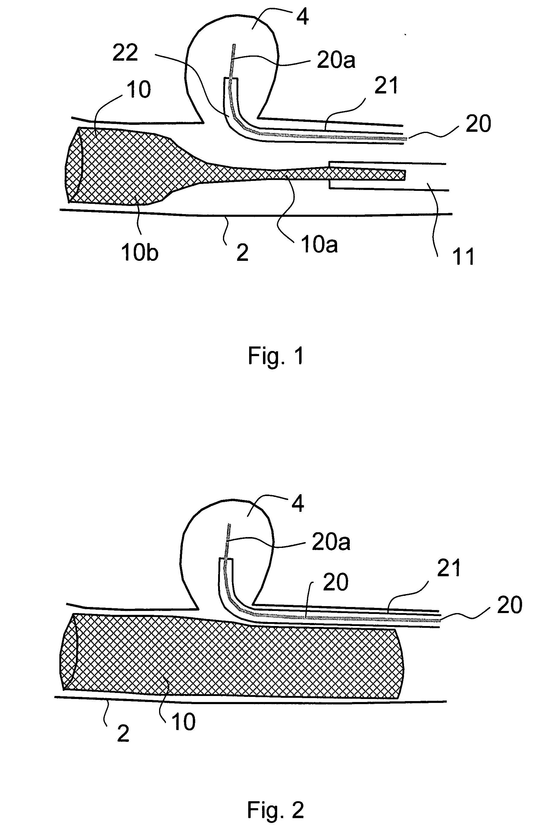 Methods and devices for reducing or blocking blood flow to a selected blood vessel or part thereof