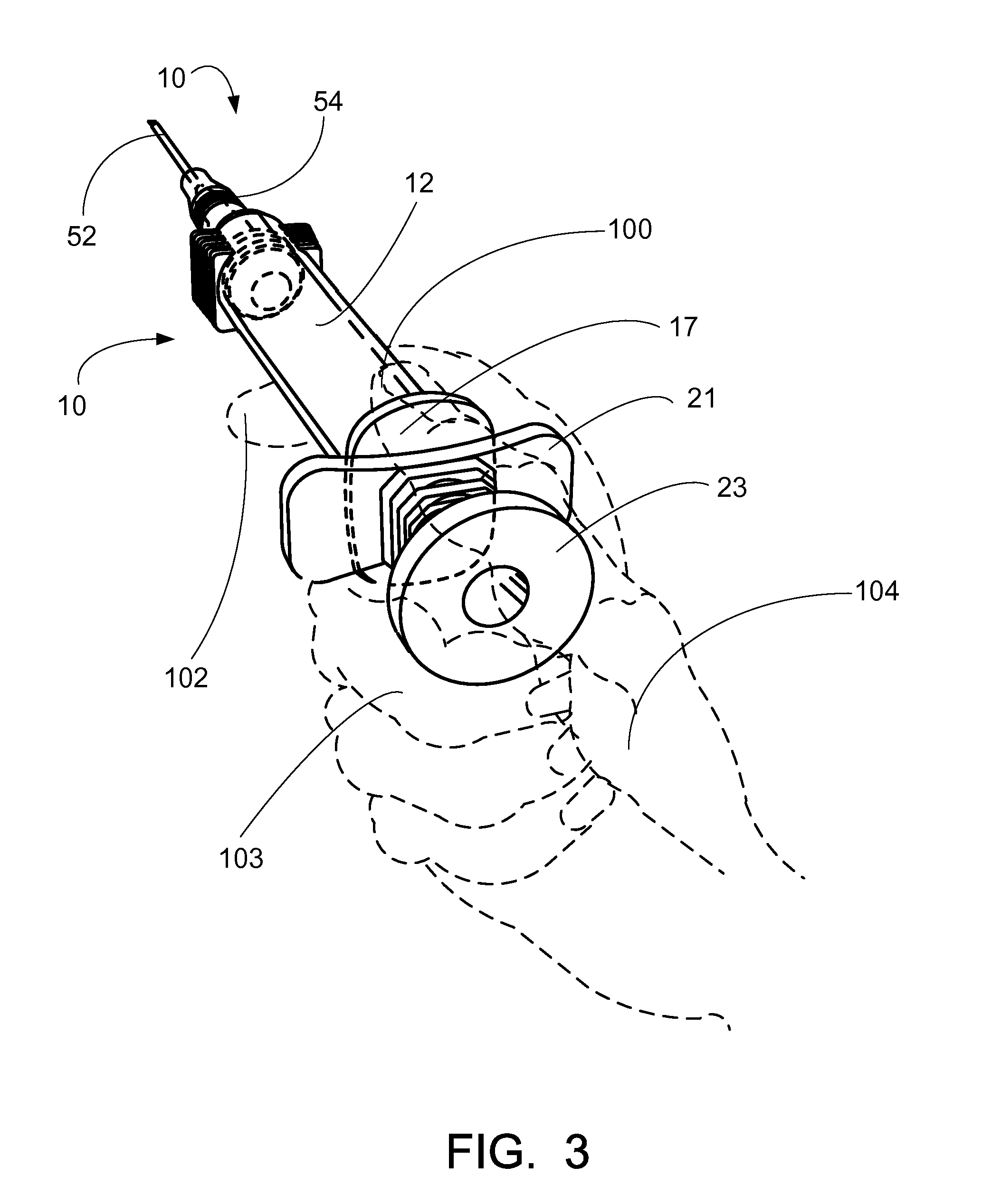 Method and apparatus for introducing an intraveneous catheter