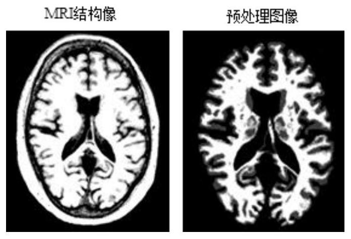 Alzheimer's disease auxiliary diagnosis system, data processing method thereof and terminal