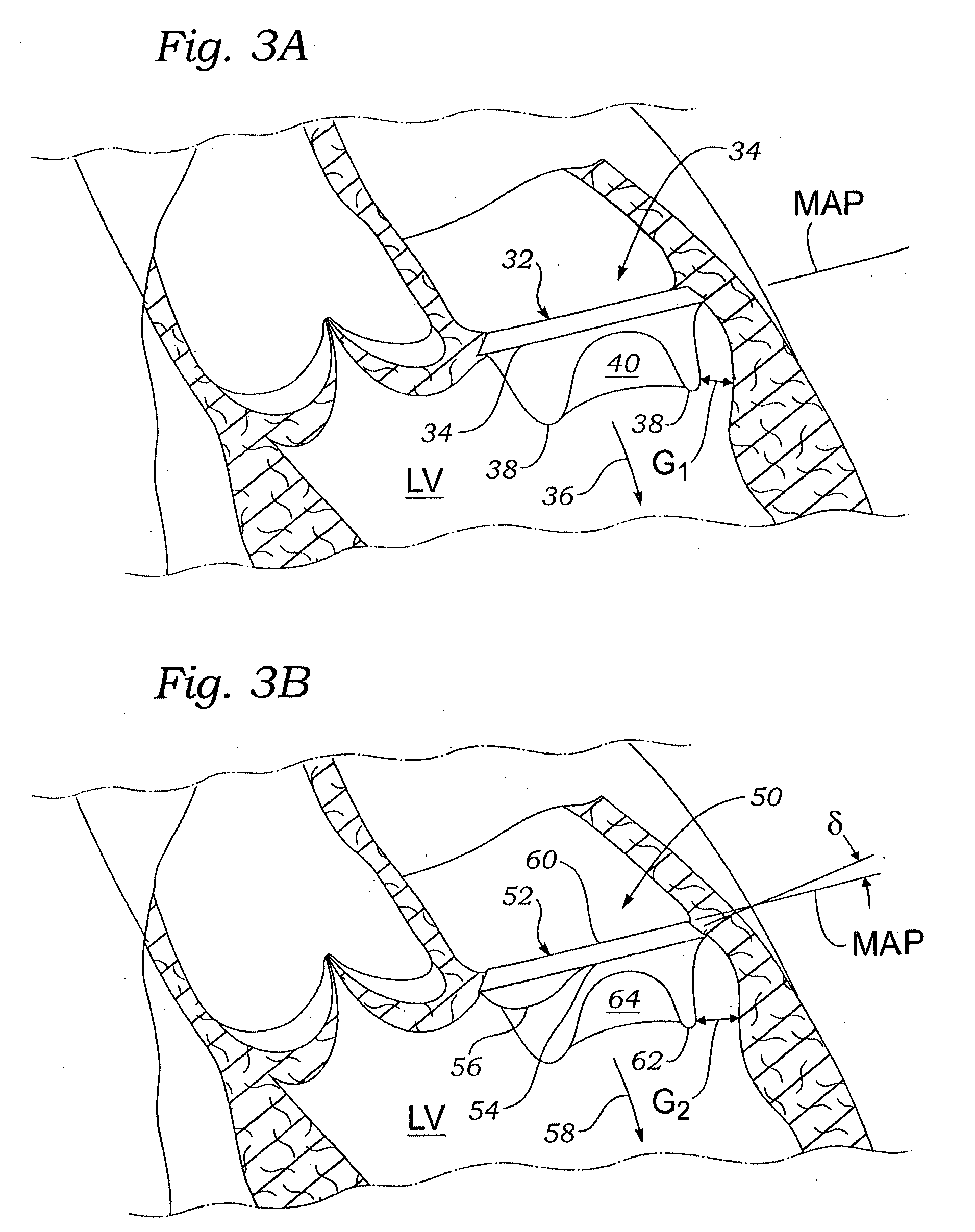 Prosthetic mitral heart valve having a contoured sewing ring