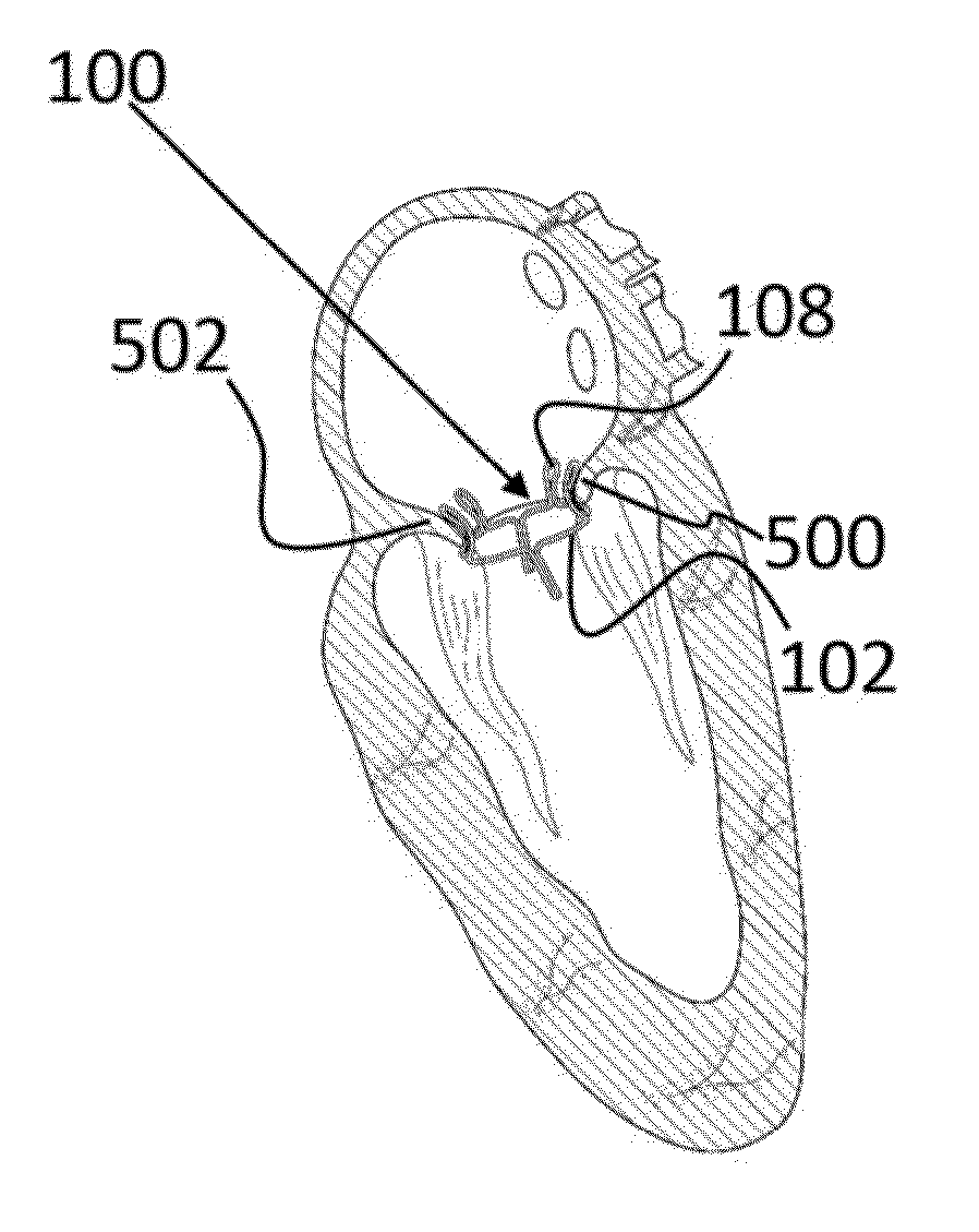 Transcatheter mitral valve