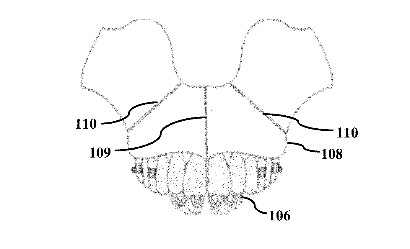 System and method for maxillary protraction in class iii malocclusion patients