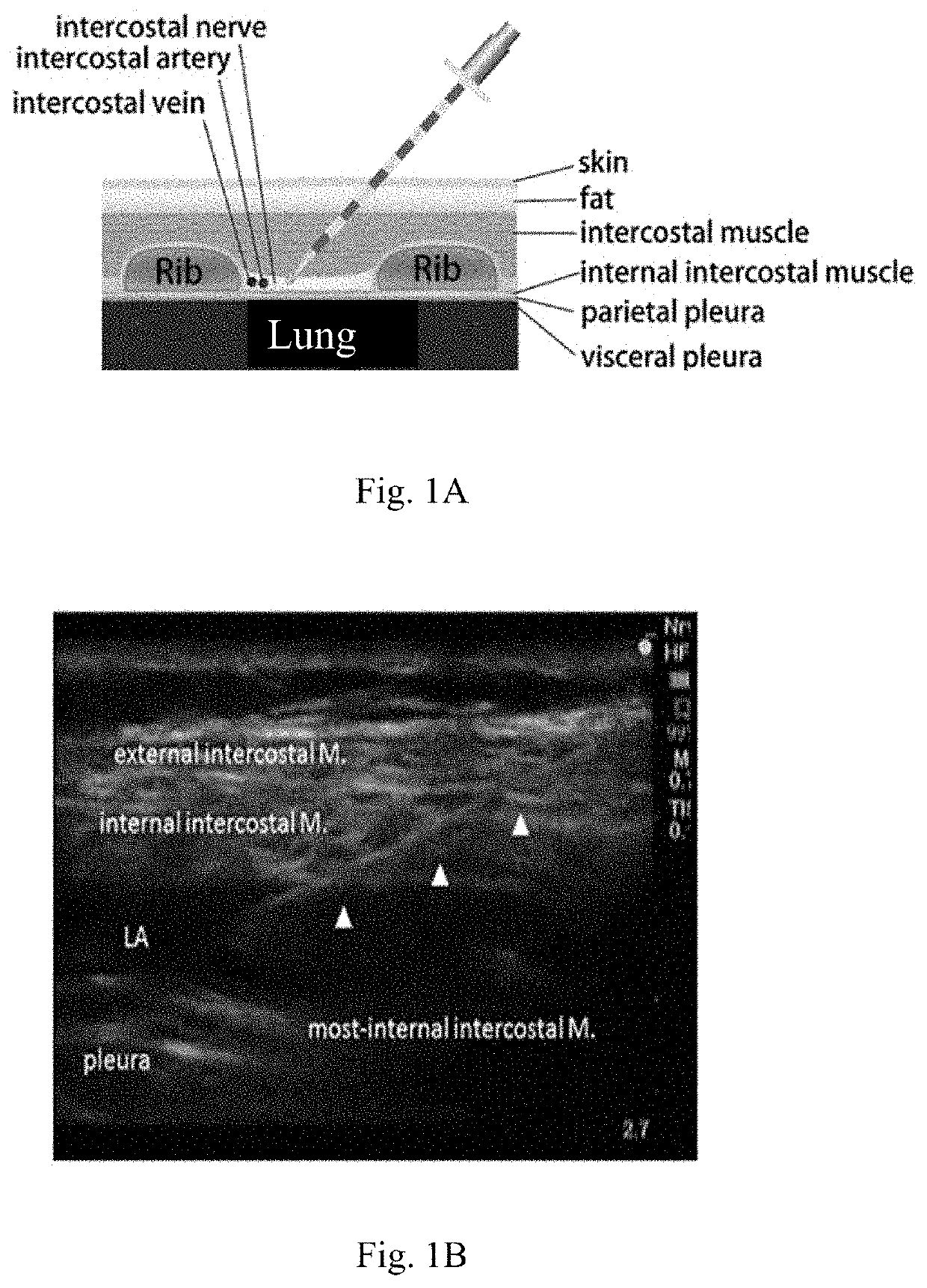 Intra-needle ultrasound system and its method of use for analysis, tracking, and display of pleura in millimeter scale resolution