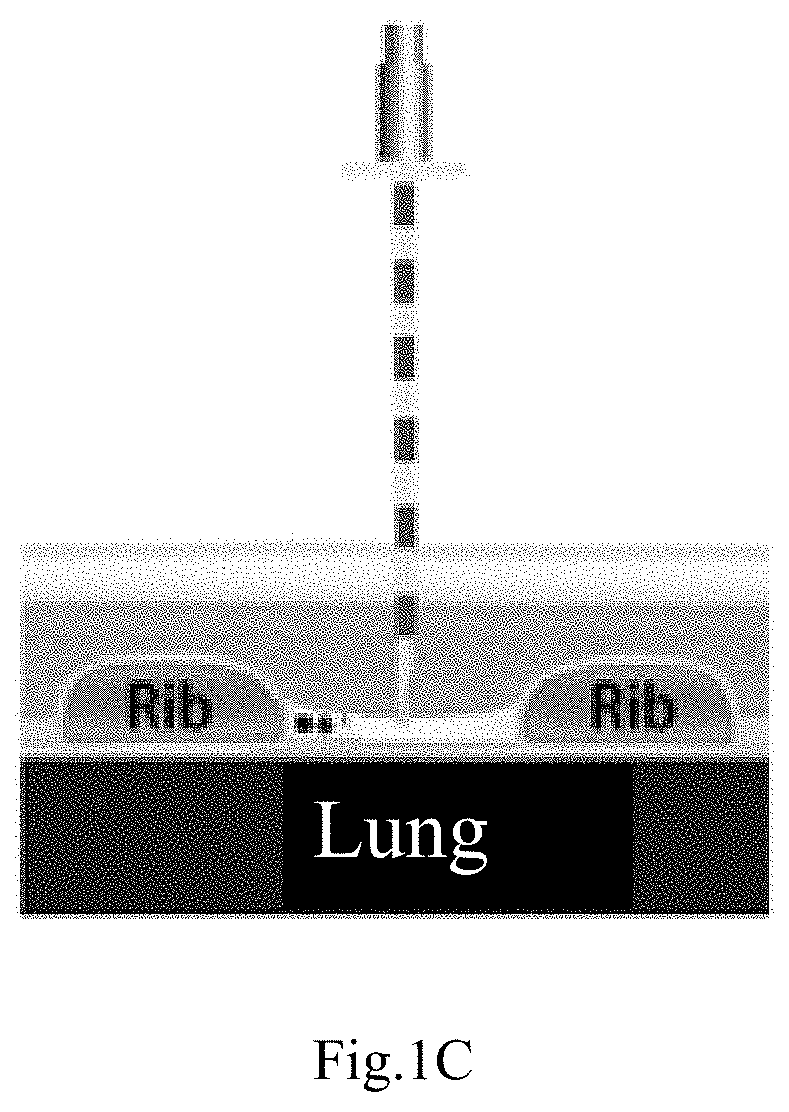 Intra-needle ultrasound system and its method of use for analysis, tracking, and display of pleura in millimeter scale resolution