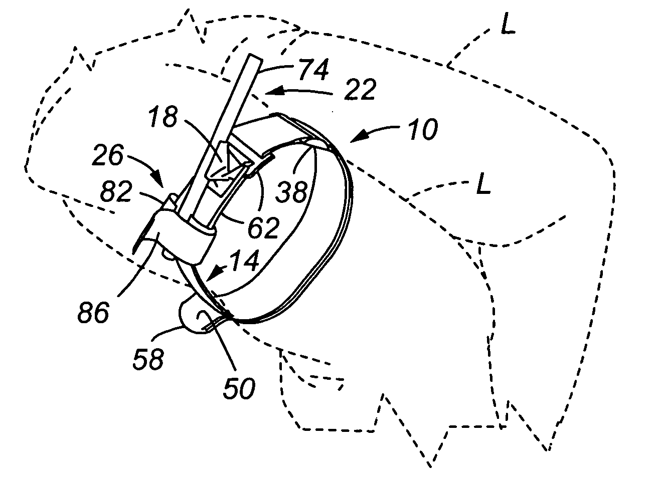 Tourniquet and method of use