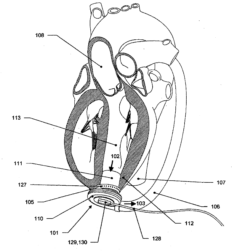 Heart assist apparatus