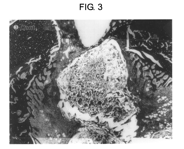 Bone regeneration material