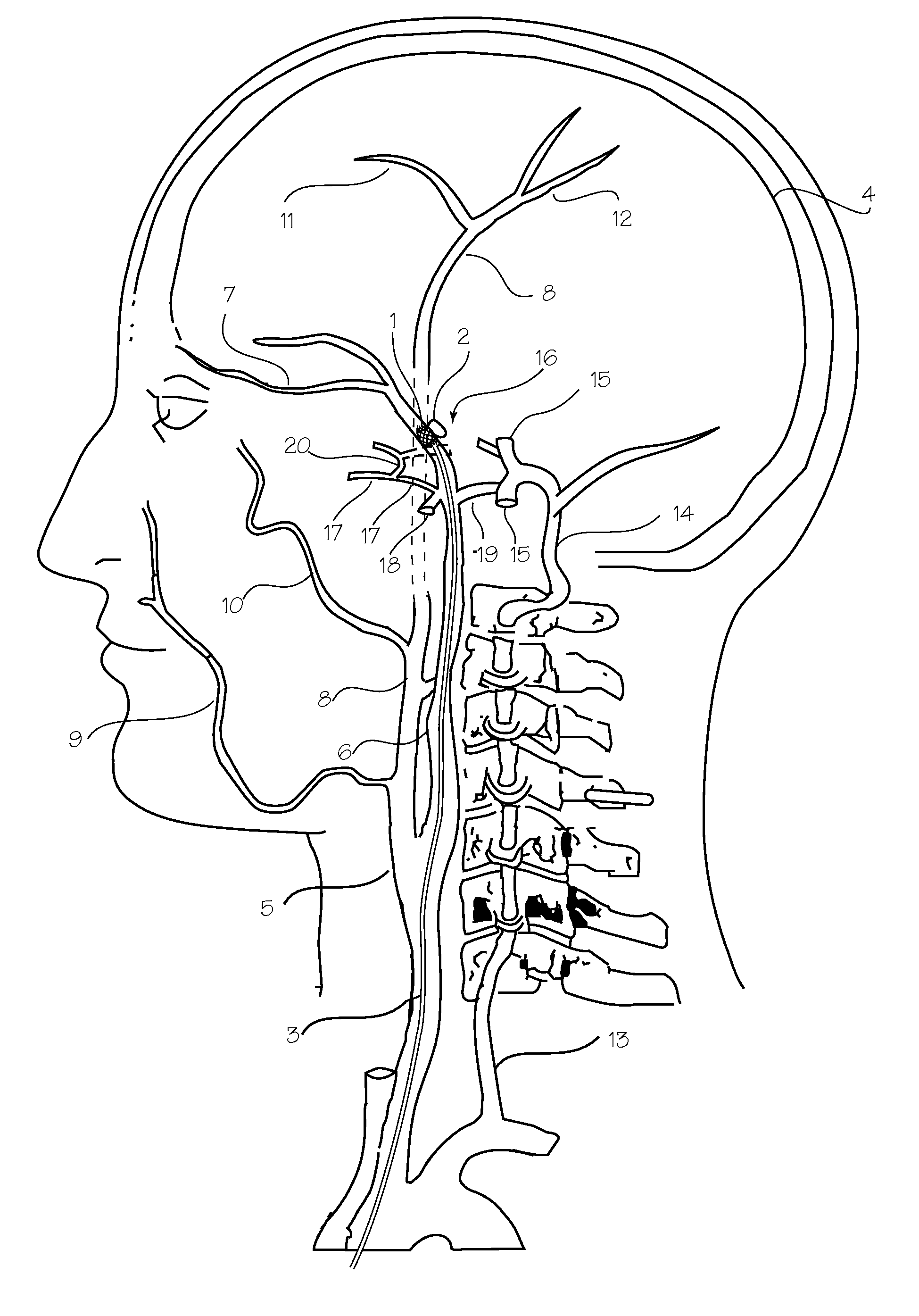 Microcatheter with Modified PTFE Liner