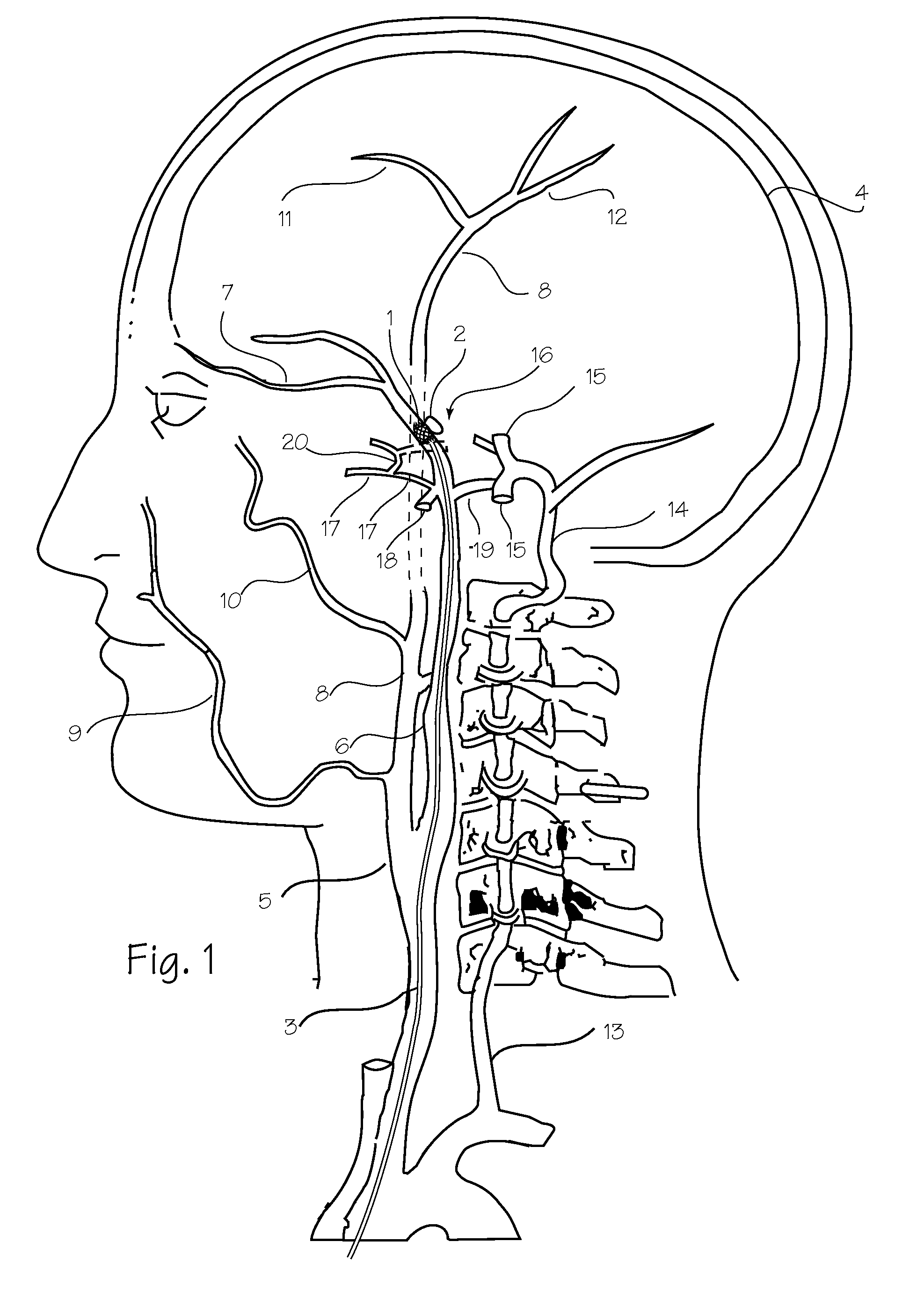 Microcatheter with Modified PTFE Liner