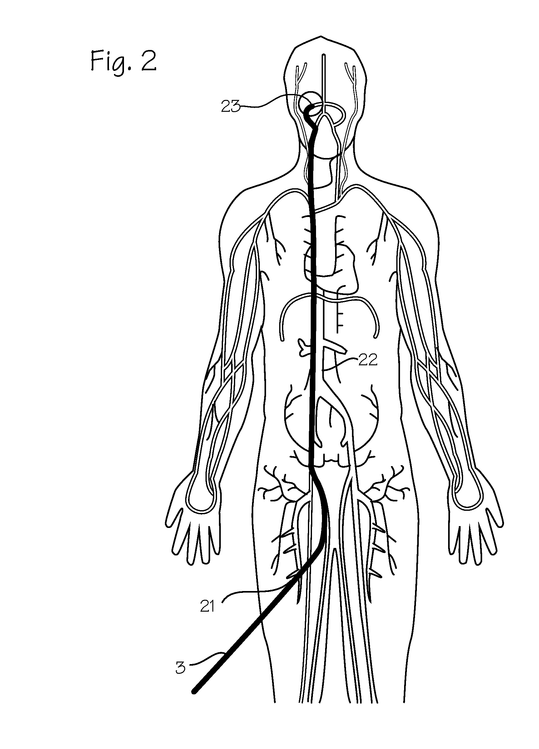 Microcatheter with Modified PTFE Liner