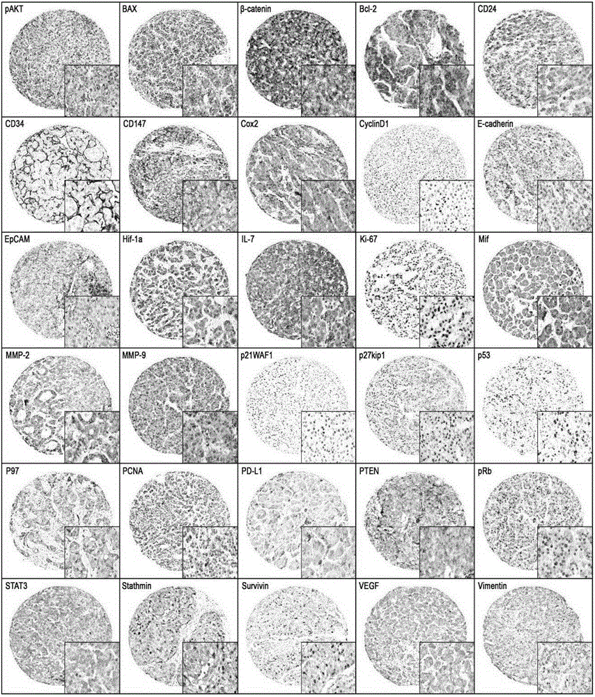 Combined diagnosis marker for predicting small hepatocellular carcinoma relapse