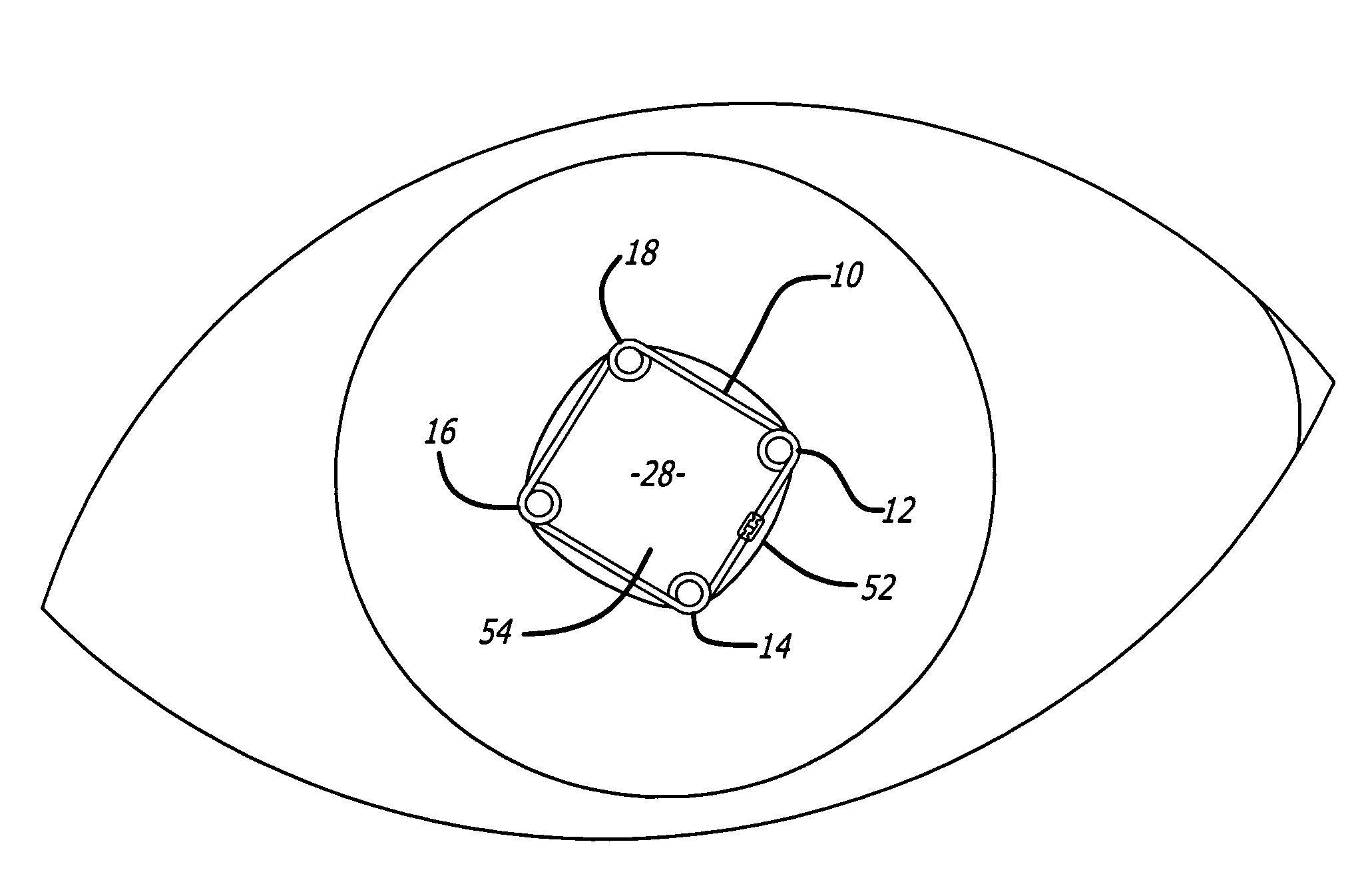 Ring used in a small pupil phacoemulsification procedure