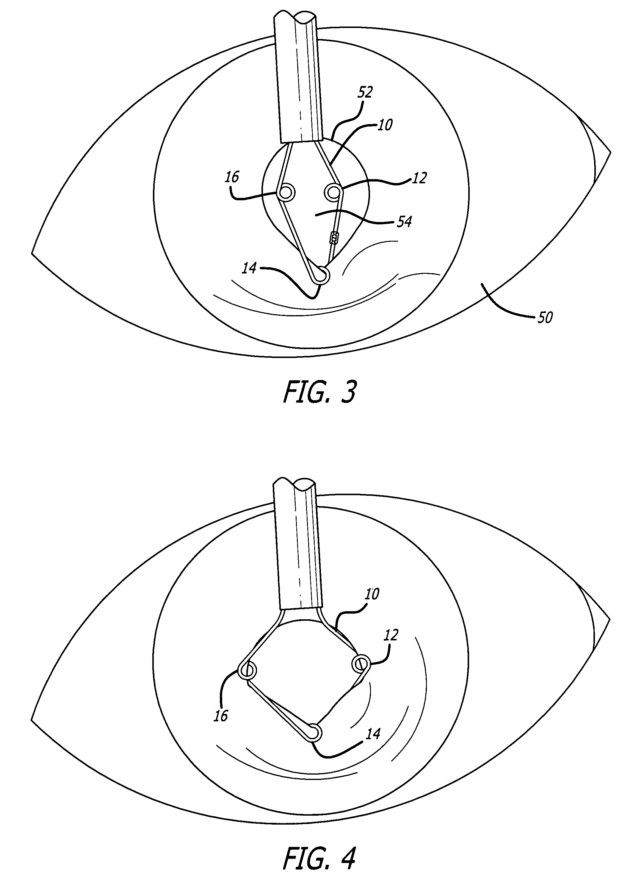 Ring used in a small pupil phacoemulsification procedure