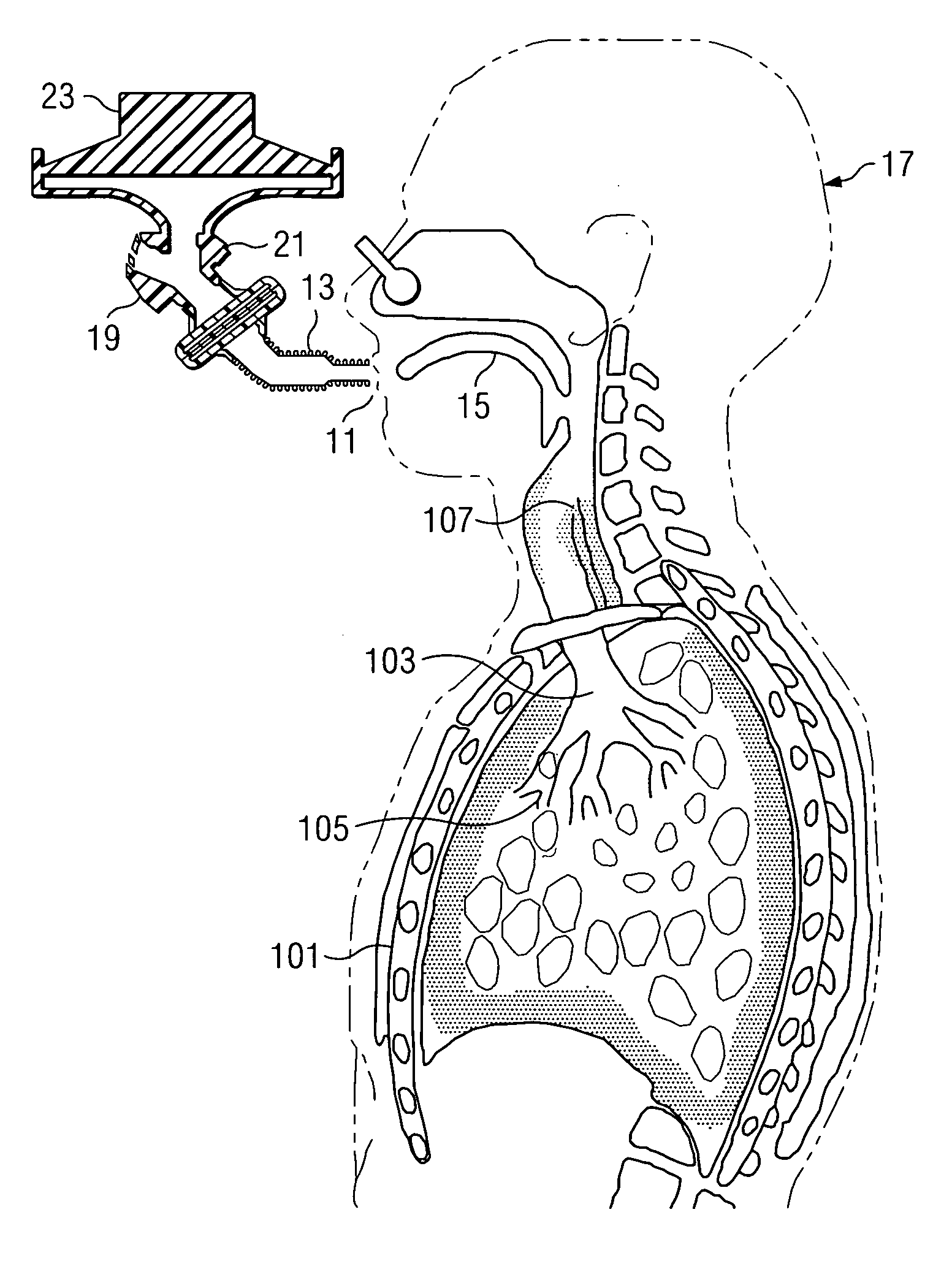 Augmented RIC model of respiratory systems