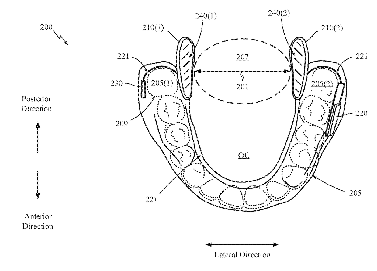 Method and apparatus for treating sleep apnea